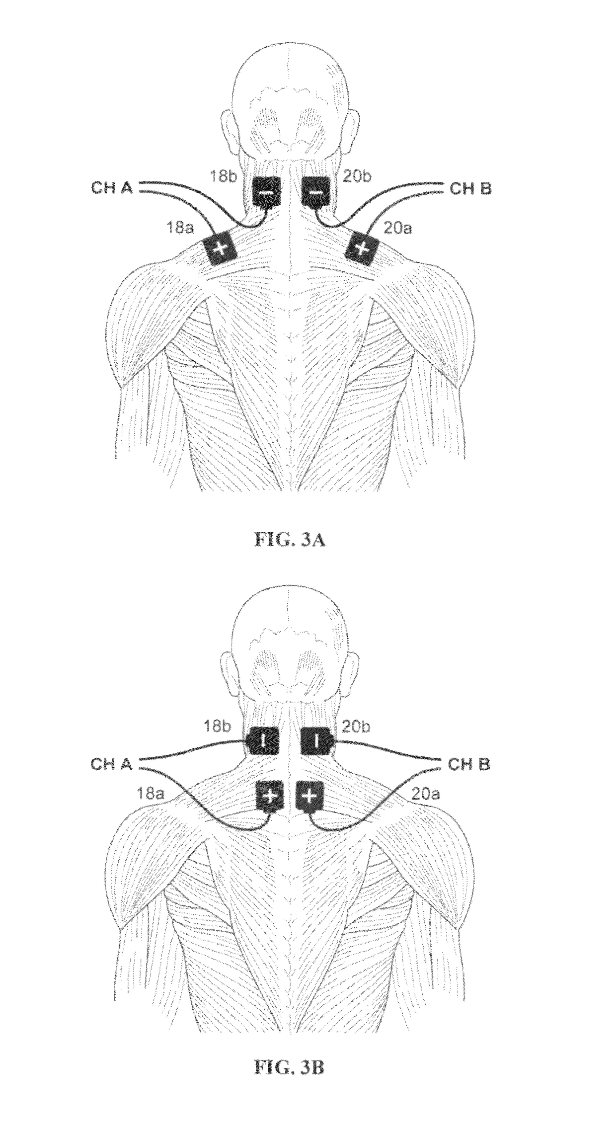 Electrical stimulation method for reduction of joint compression