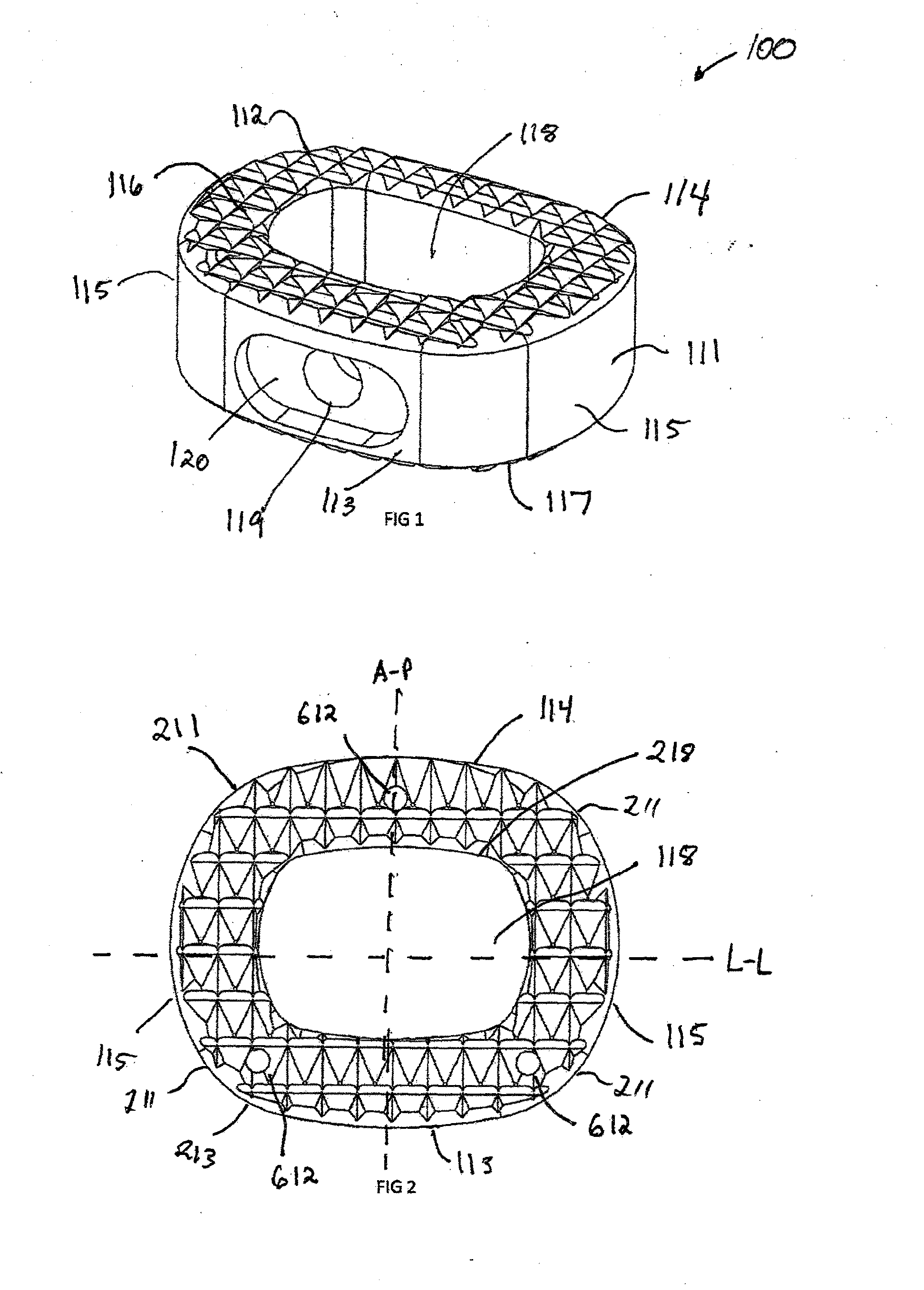 Wedge Osteotomy Device and Method Of Use
