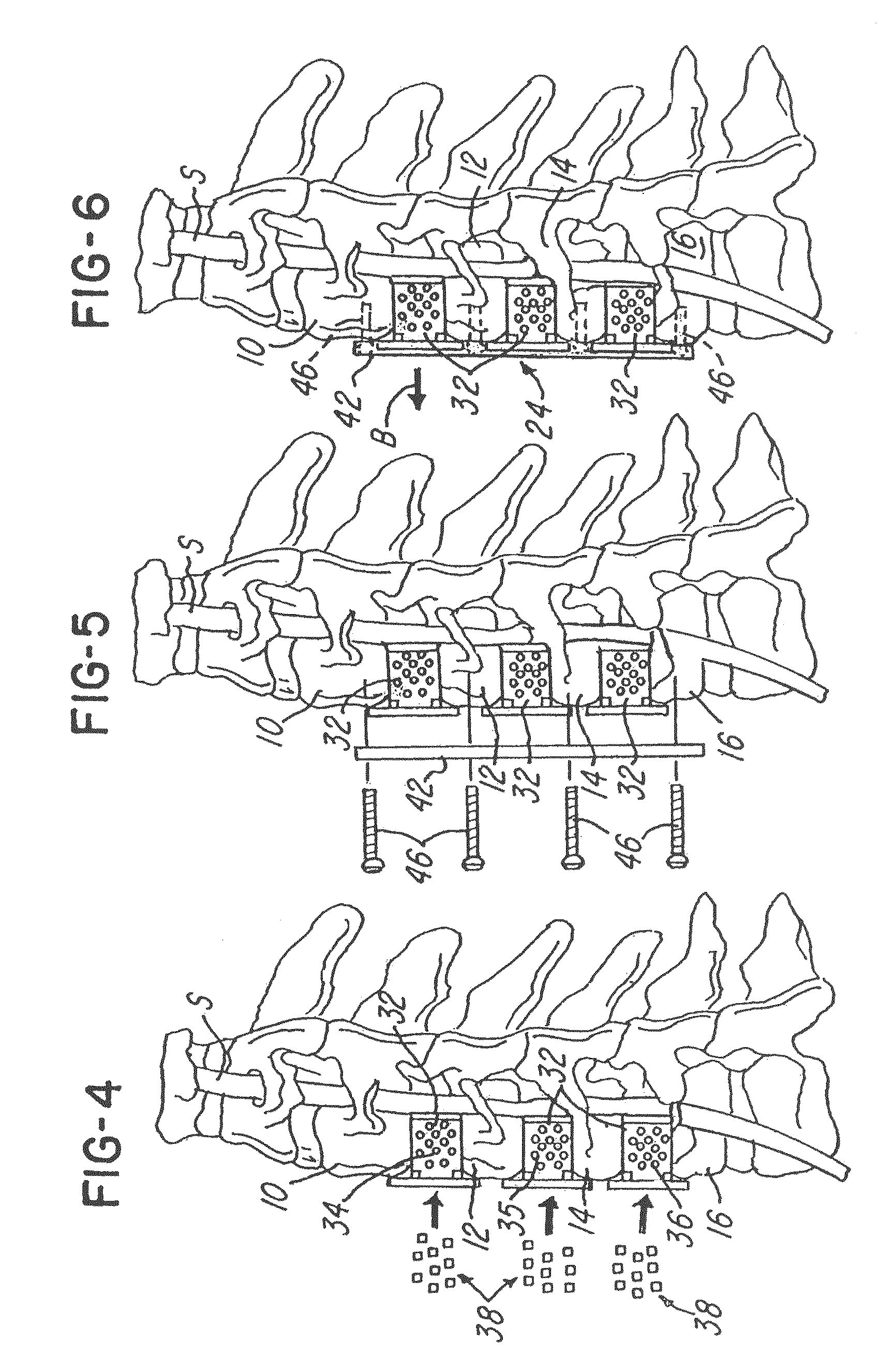 Spinal fusion system and method for fusing spinal bones