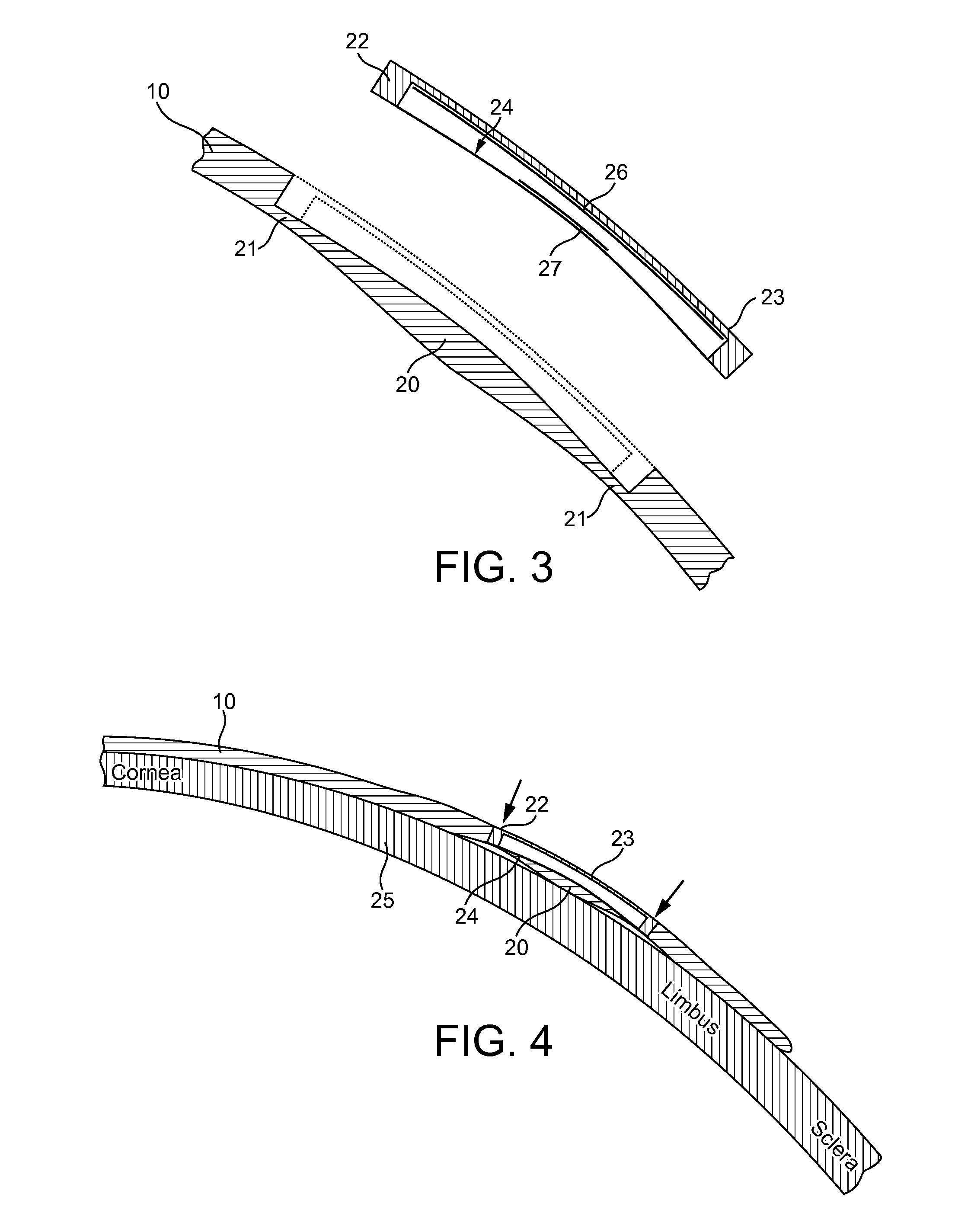 Device for monitoring intraocular pressure