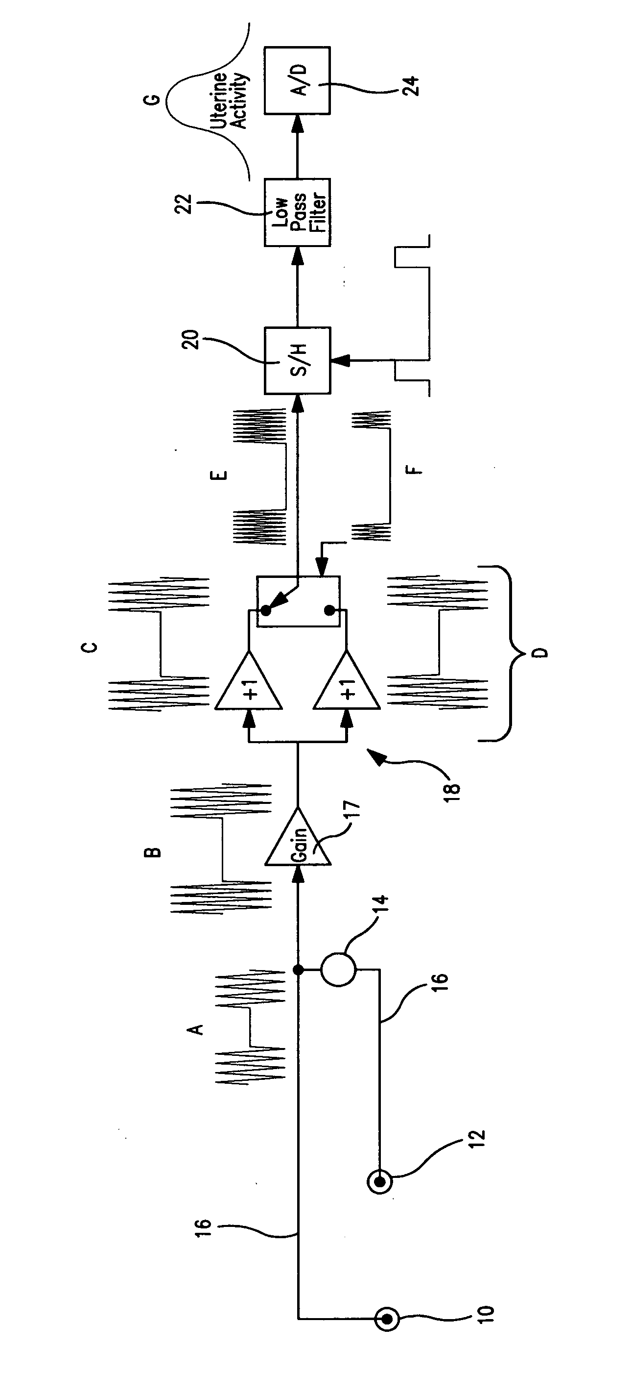 Uterine activity monitoring using impedance plethysmography