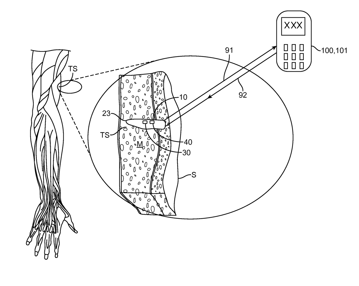 Implantable oximetric measurement apparatus and method of use