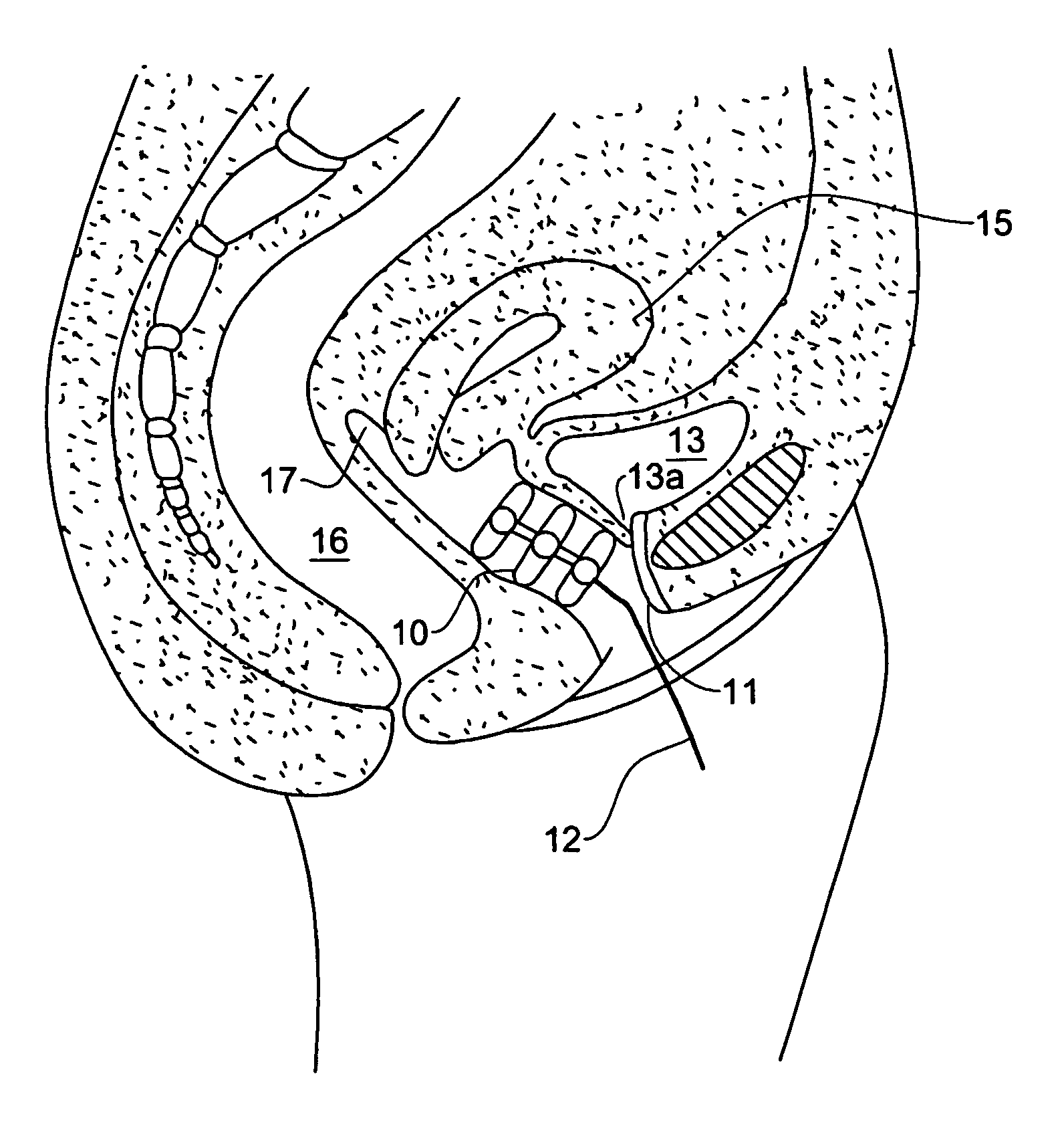 Device For The Prevention Of Urinary Incontinence In Females