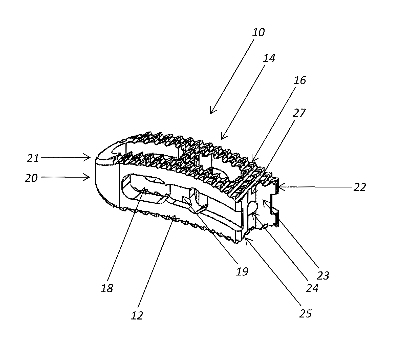 Intervertebral implant device for a posterior interbody fusion surgical procedure