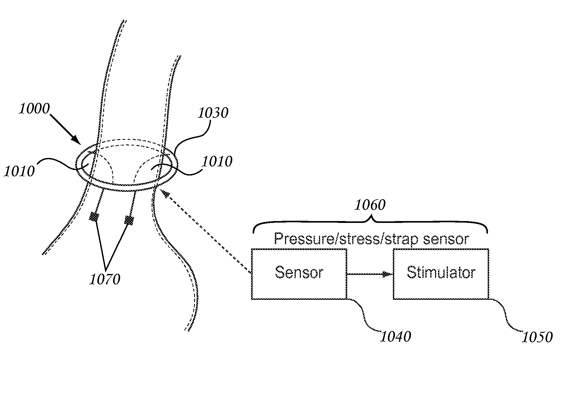 Closed Loop Gastric Restriction Devices and Methods