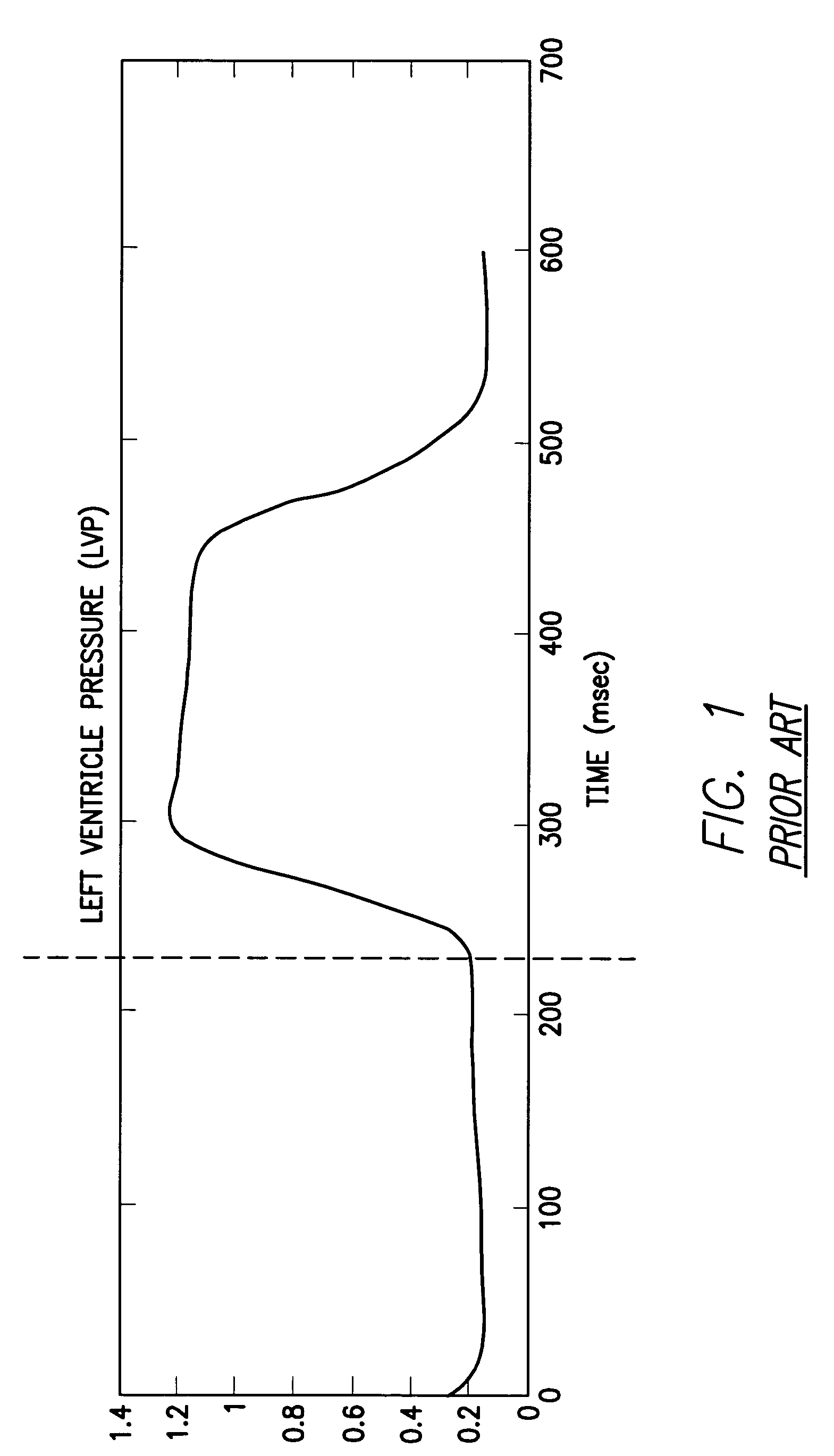 System and method for detecting heart failure and pulmonary edema based on ventricular end-diastolic pressure using an implantable medical device