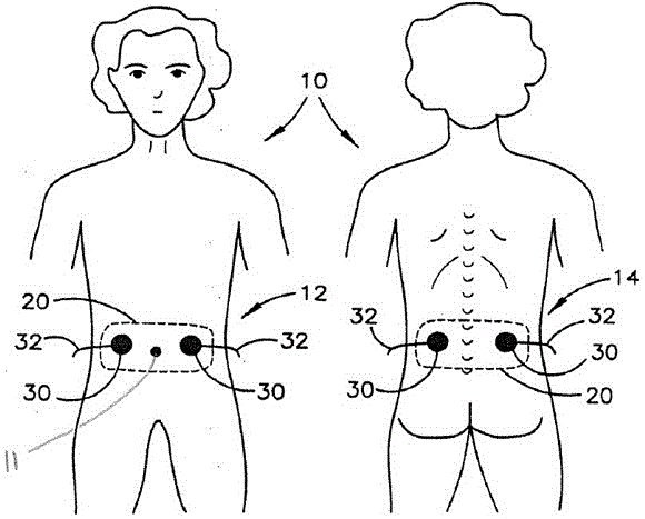 Transdermal stimulation methods and systems