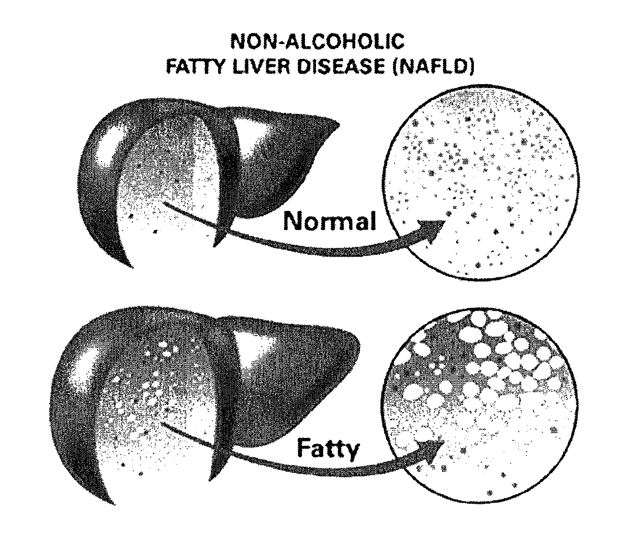 Method and system for reducing the likelihood of developing NASH in an individual diagnosed with non-alcoholic fatty liver disease