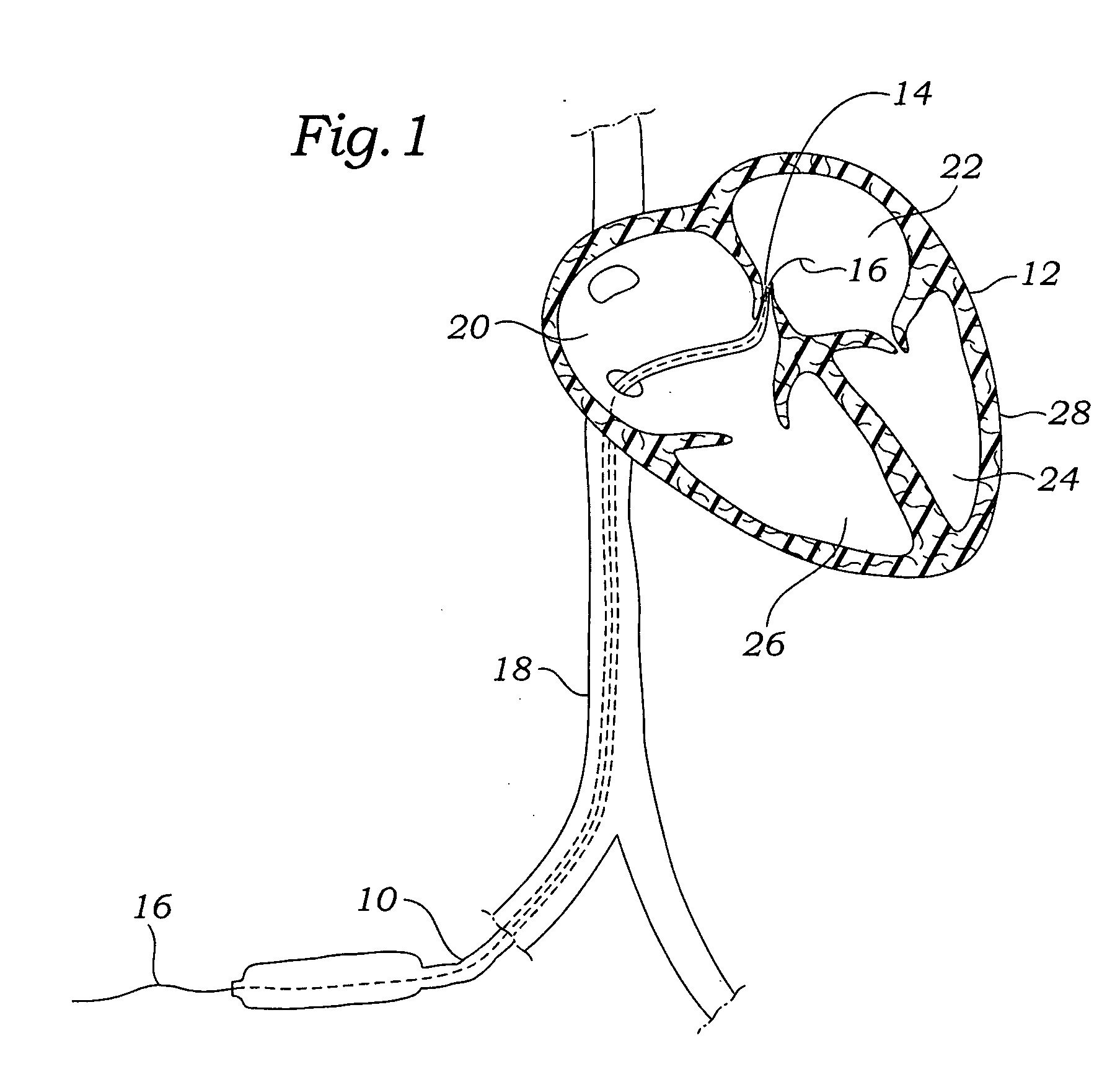 System, apparatus, and method for repairing septal defects