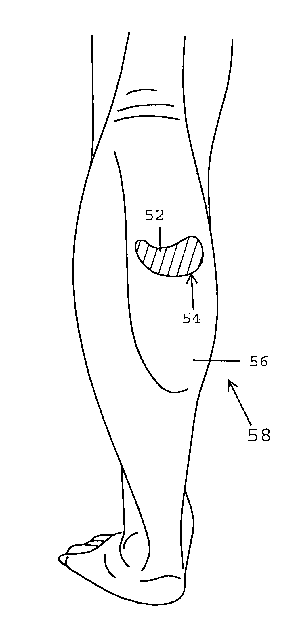 Devices and methods for manipulating circulation in the circulatory system of a patient