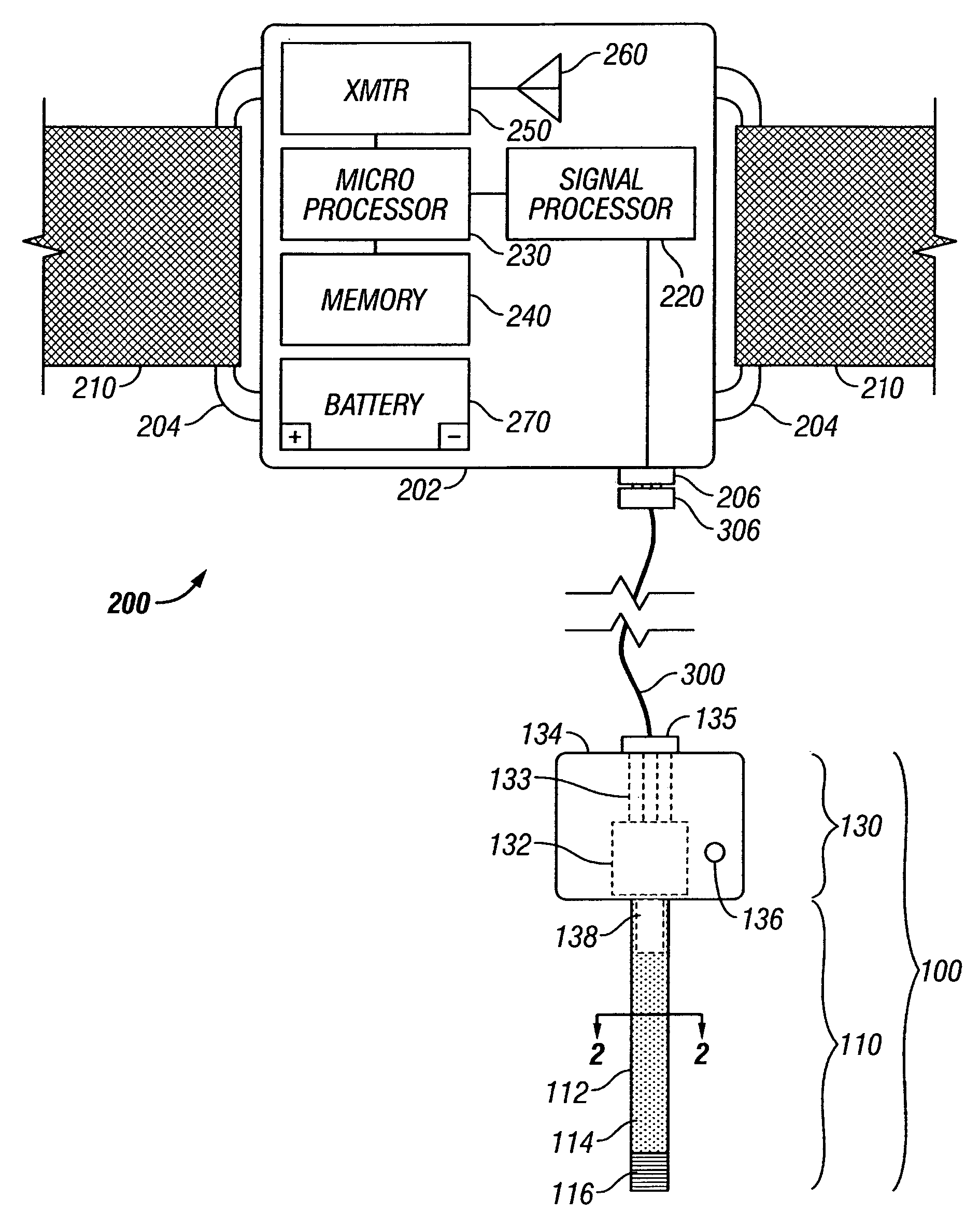 Vascular blood pressure monitoring system with transdermal catheter and telemetry capability