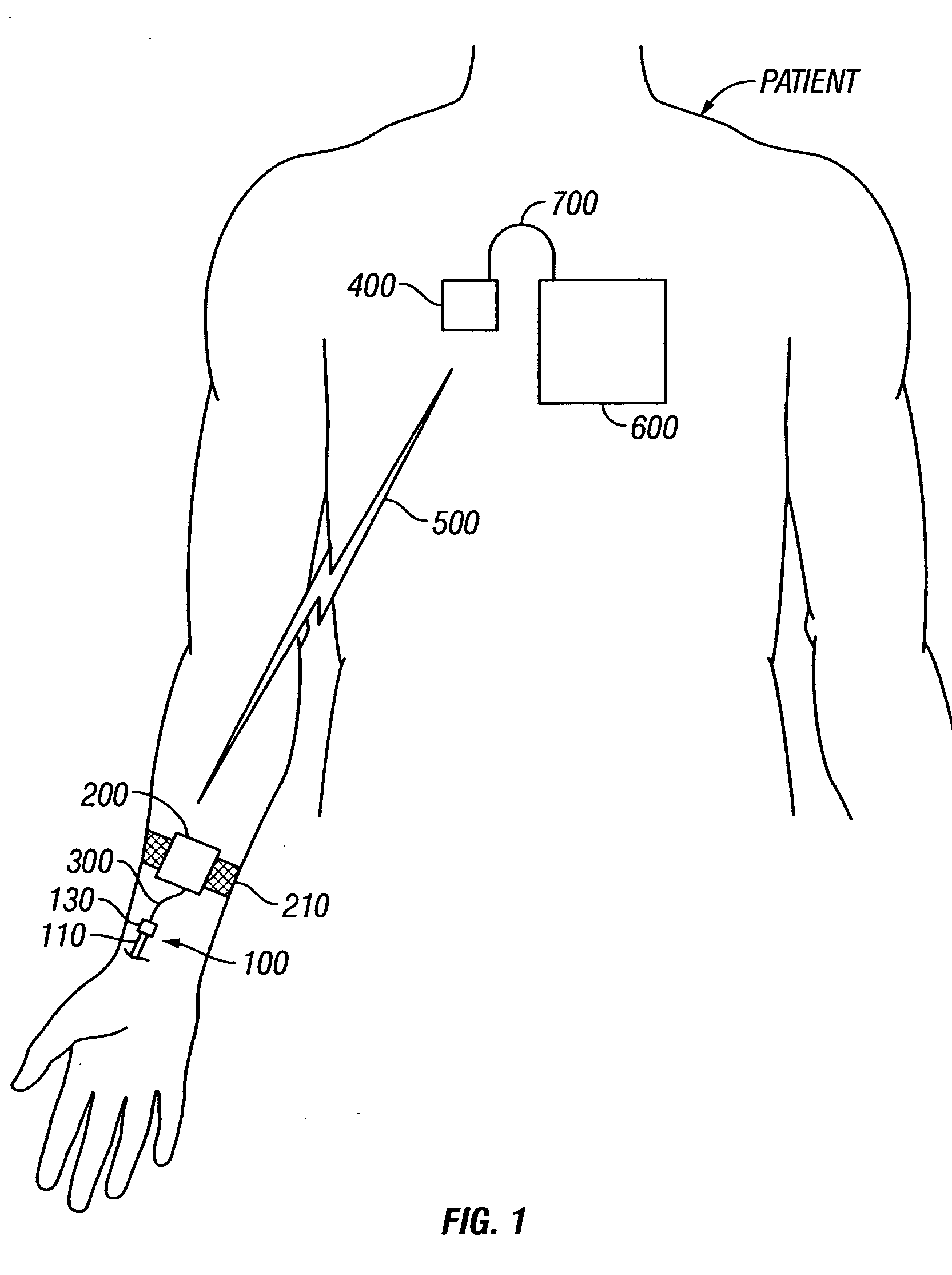 Vascular blood pressure monitoring system with transdermal catheter and telemetry capability