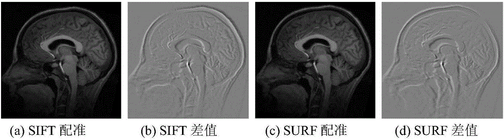 Non-rigid image registration method based on image feature and Demons