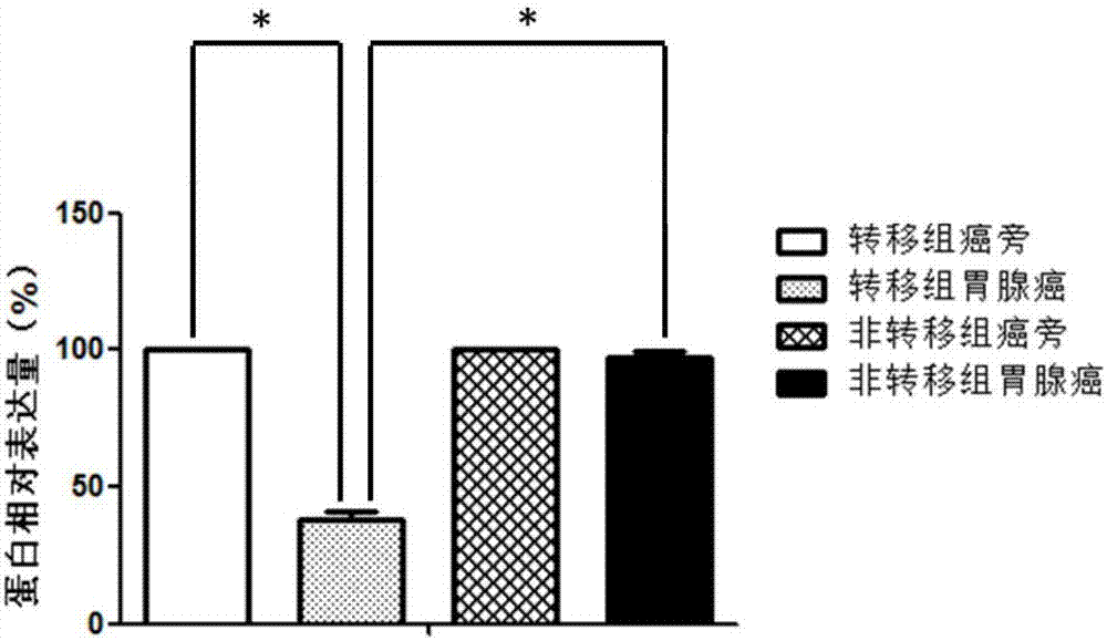 Diagnosis and treatment tool for metastasis of gastric adenocarcinoma