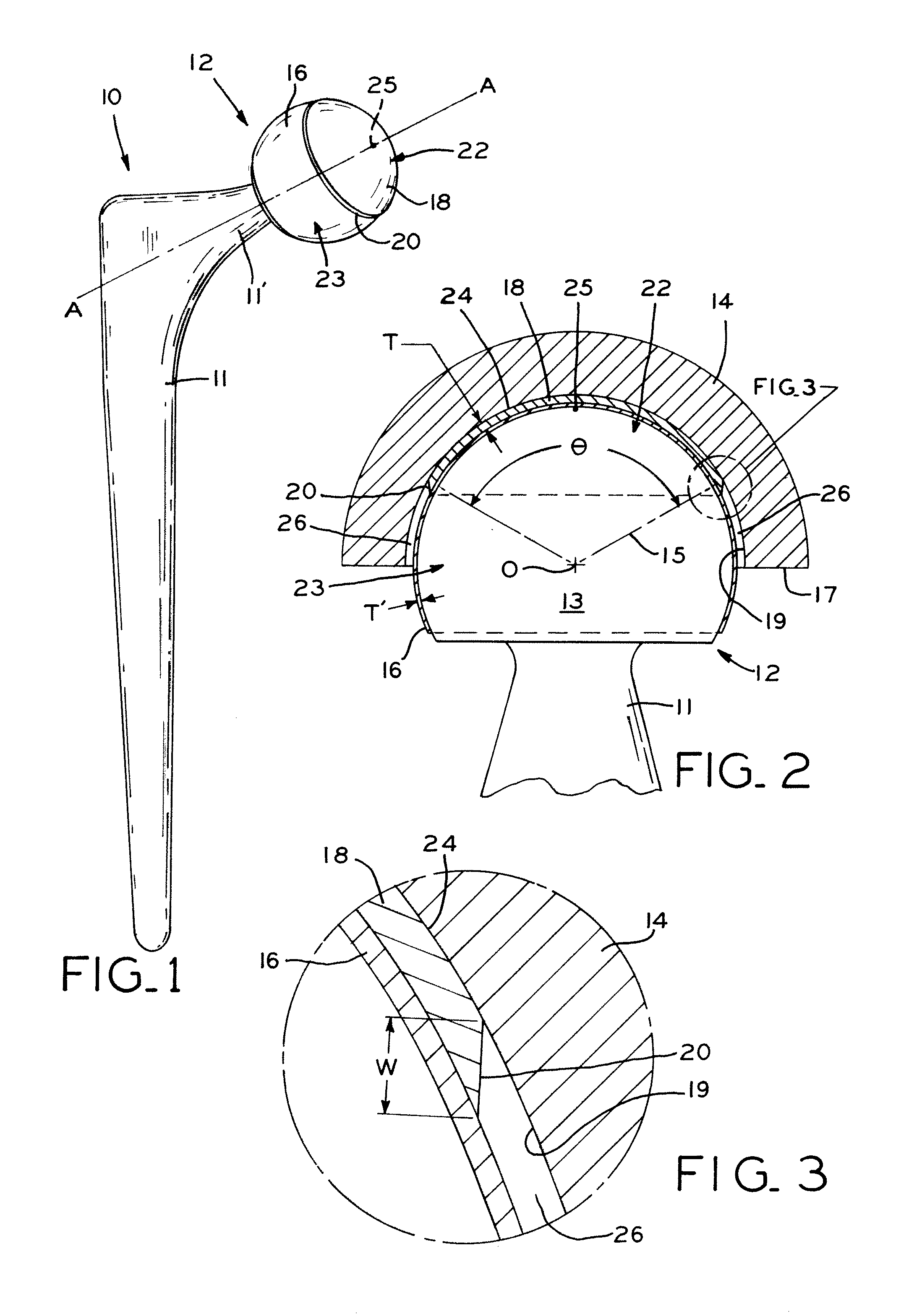 Bi-material prosthesis component