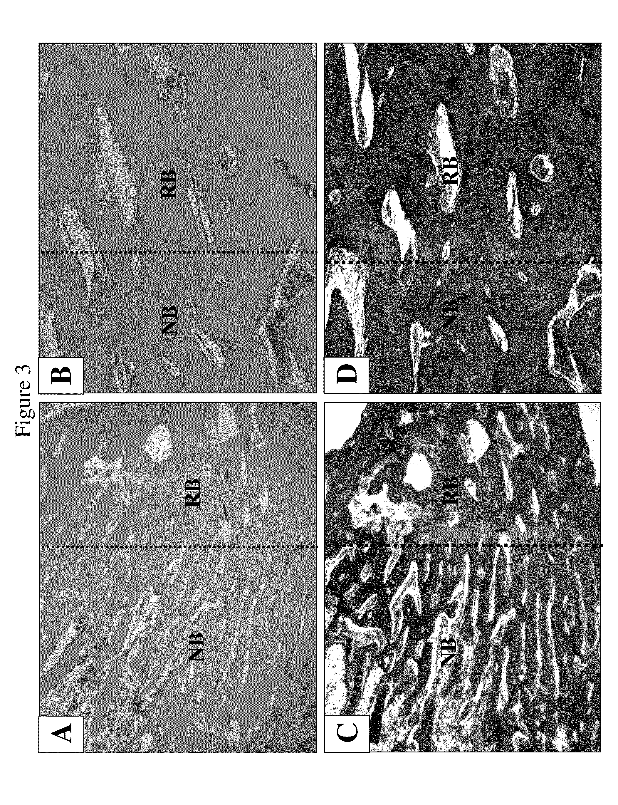 Method for healing bone fracture using transfected chondrocytes