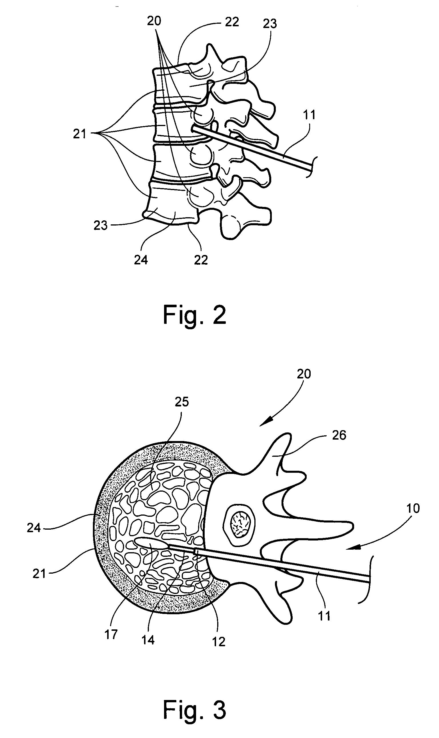 Bone barrier device, system, and method