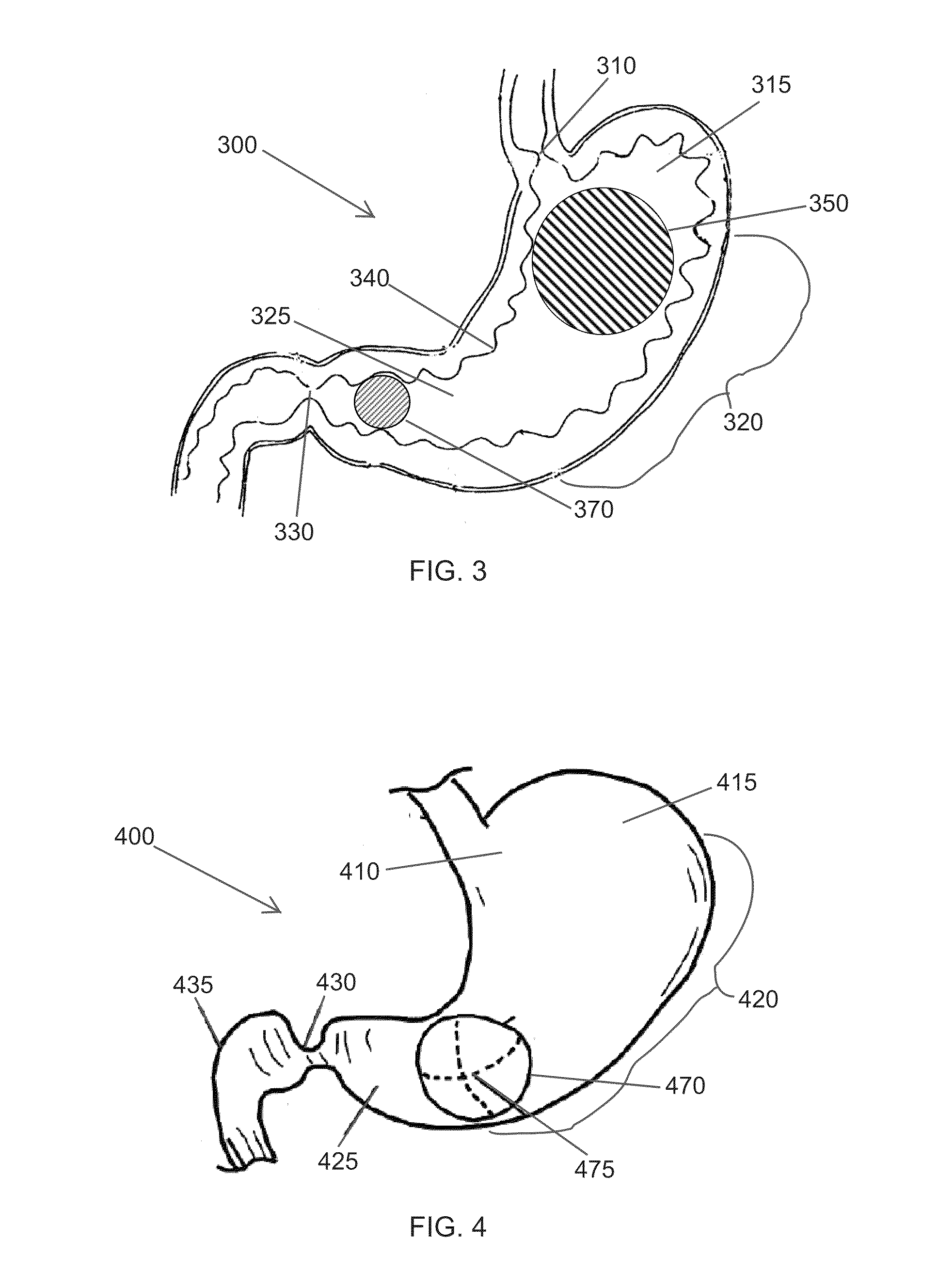 High specific gravity intragastric device