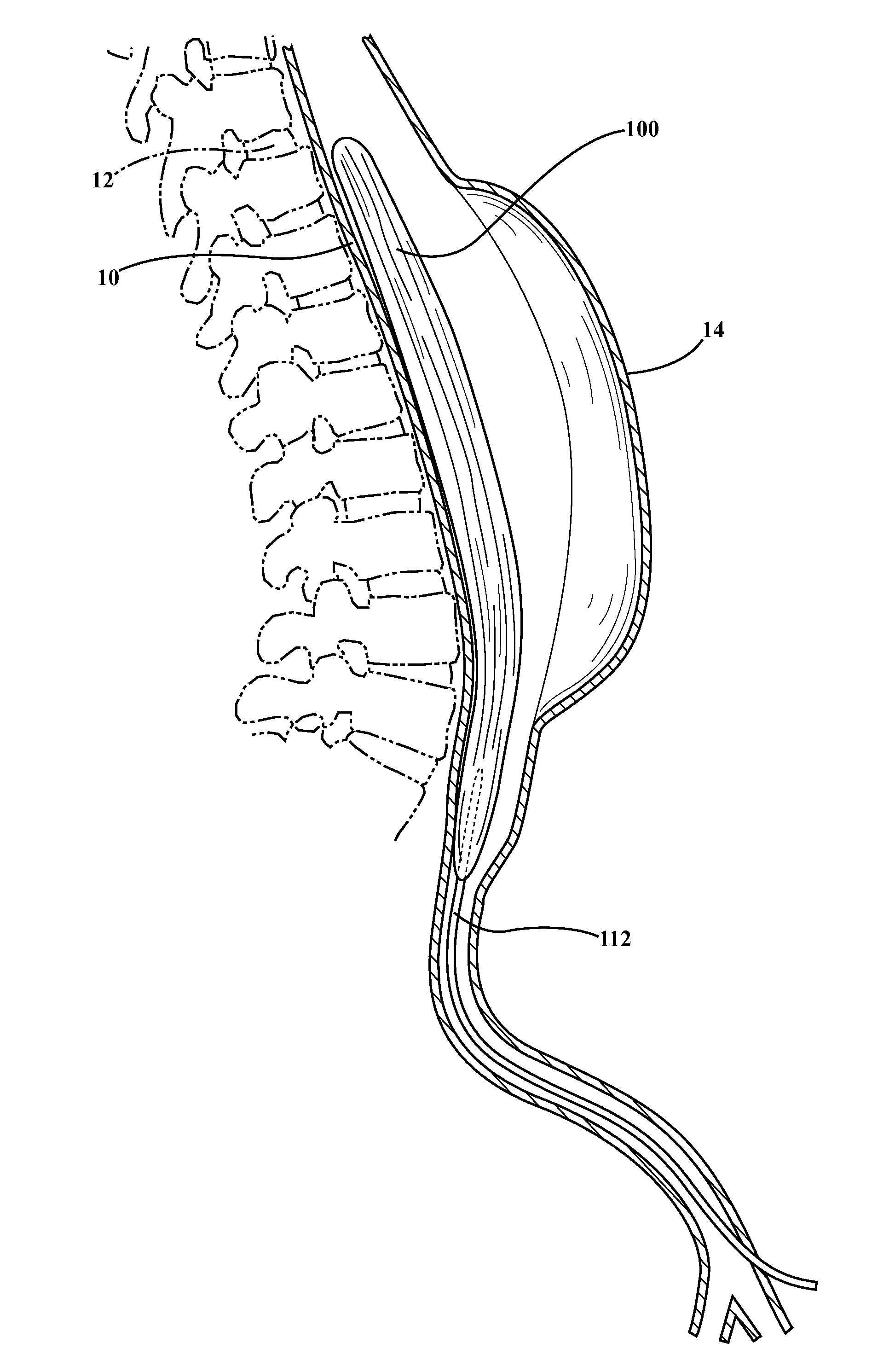 Lumbar ostia occlusion devices and methods of deploying the same