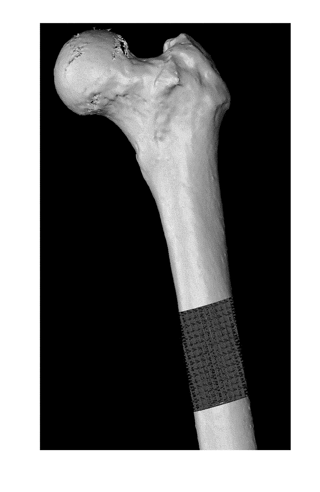 Osteoconductive and Osteoinductive Implant for Augmentation, Stabilization, or Defect Reconstruction