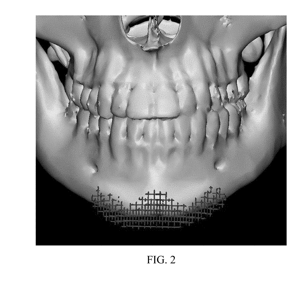 Osteoconductive and Osteoinductive Implant for Augmentation, Stabilization, or Defect Reconstruction