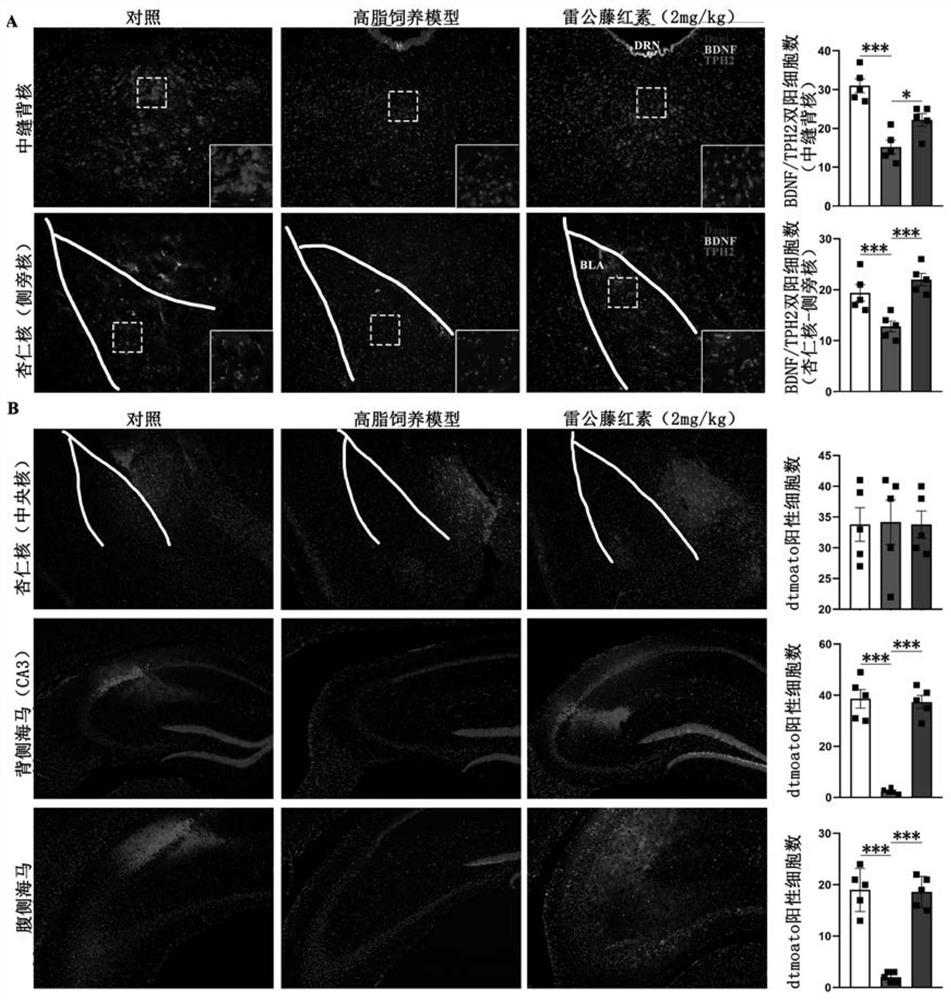 Application of Tripterygium in the Preparation of Drugs for Treating Complicated Refractory Depression