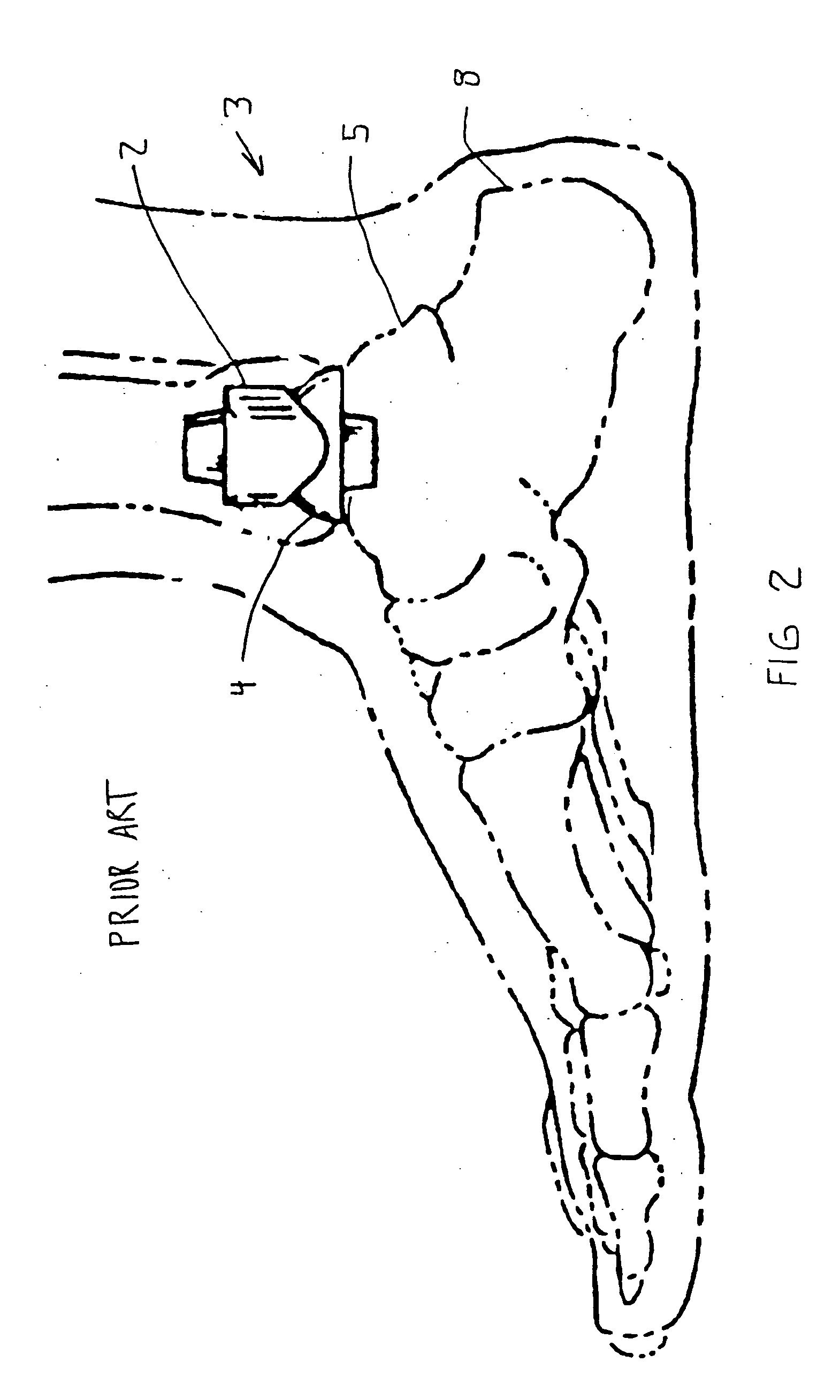 Modular ankle prosthesis and associated method