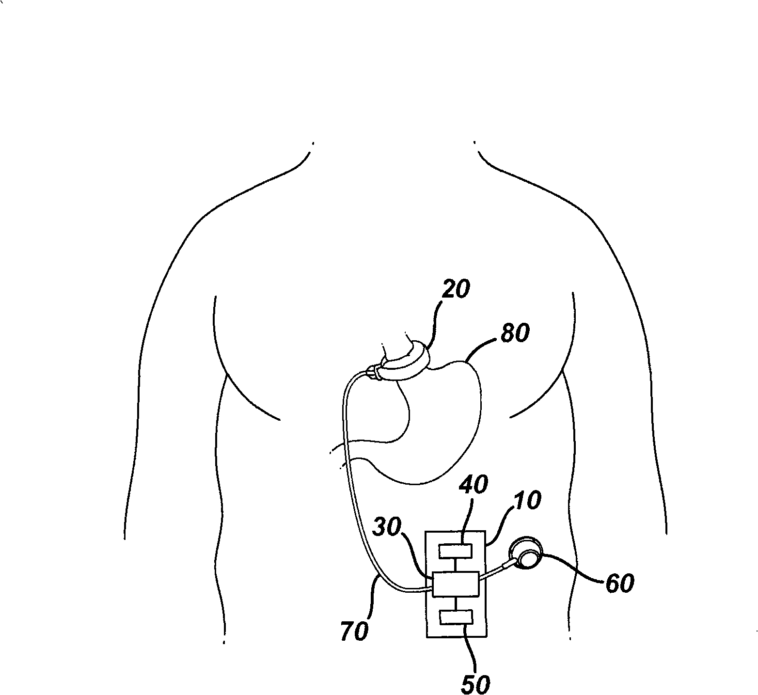 Fluid logic for regulating restriction devices