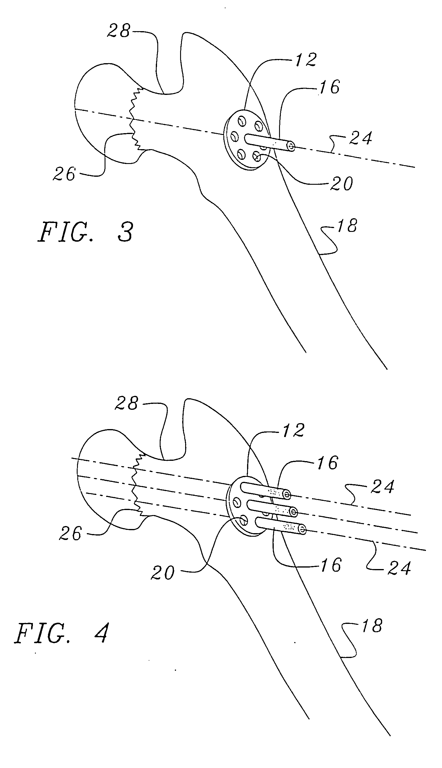 Bone end (epiphysis) fracture fixation device and method of use