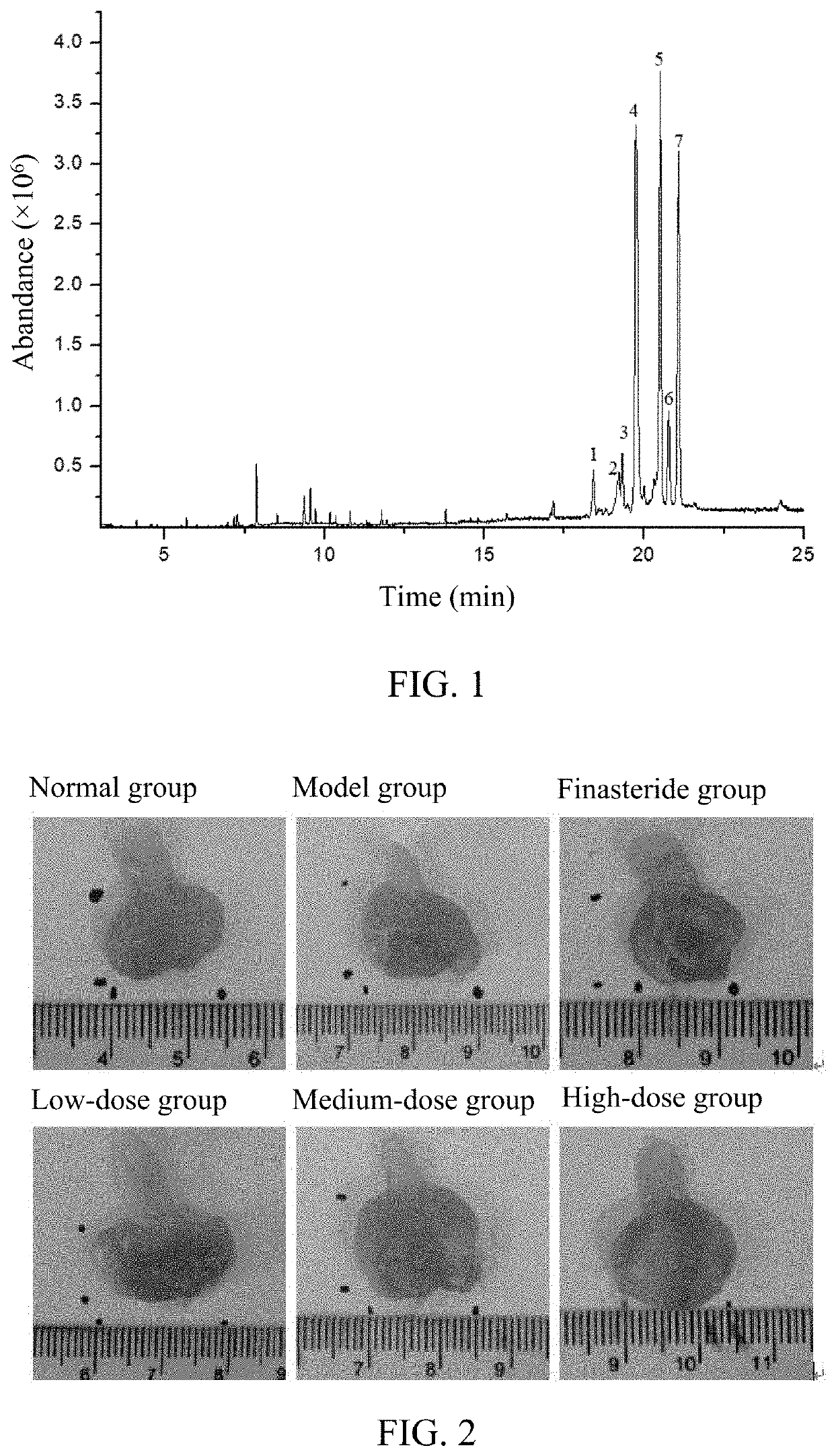 Sterol composition in pumpkin seed oil and application thereof, and drug for treating benign prostatic hyperplasia