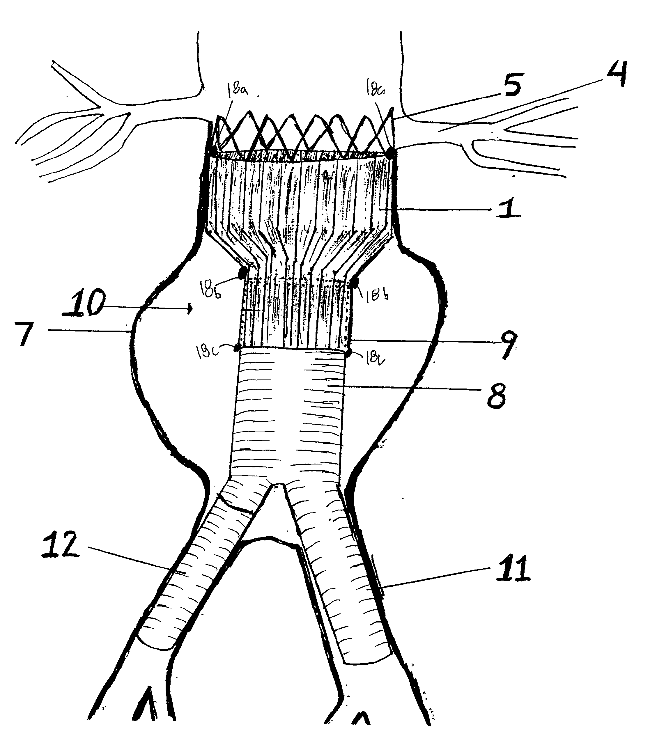 Tapered endovascular stent graft and method of treating abdominal aortic aneurysms and distal iliac aneurysms