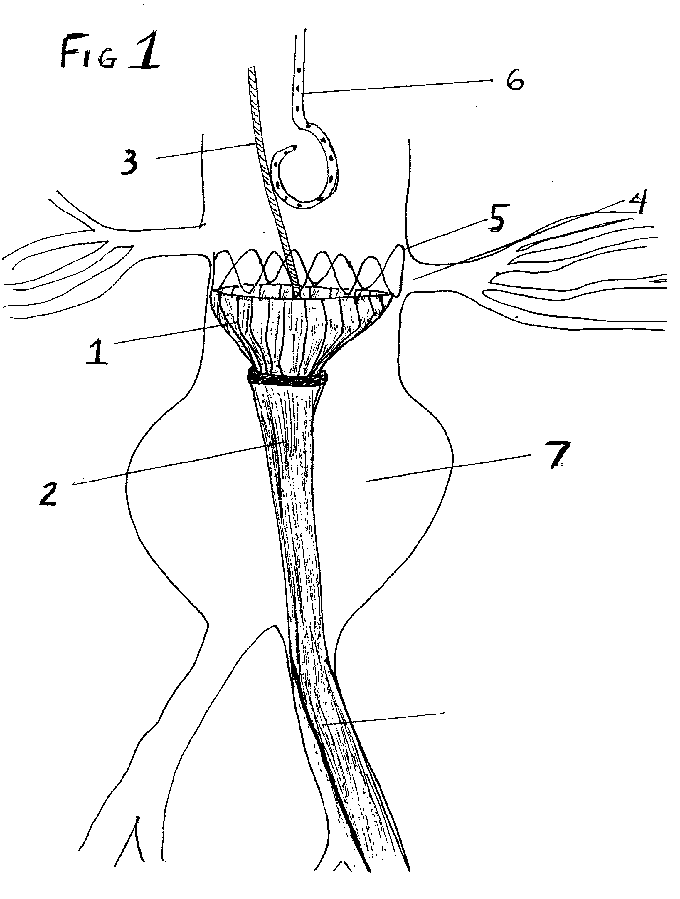 Tapered endovascular stent graft and method of treating abdominal aortic aneurysms and distal iliac aneurysms