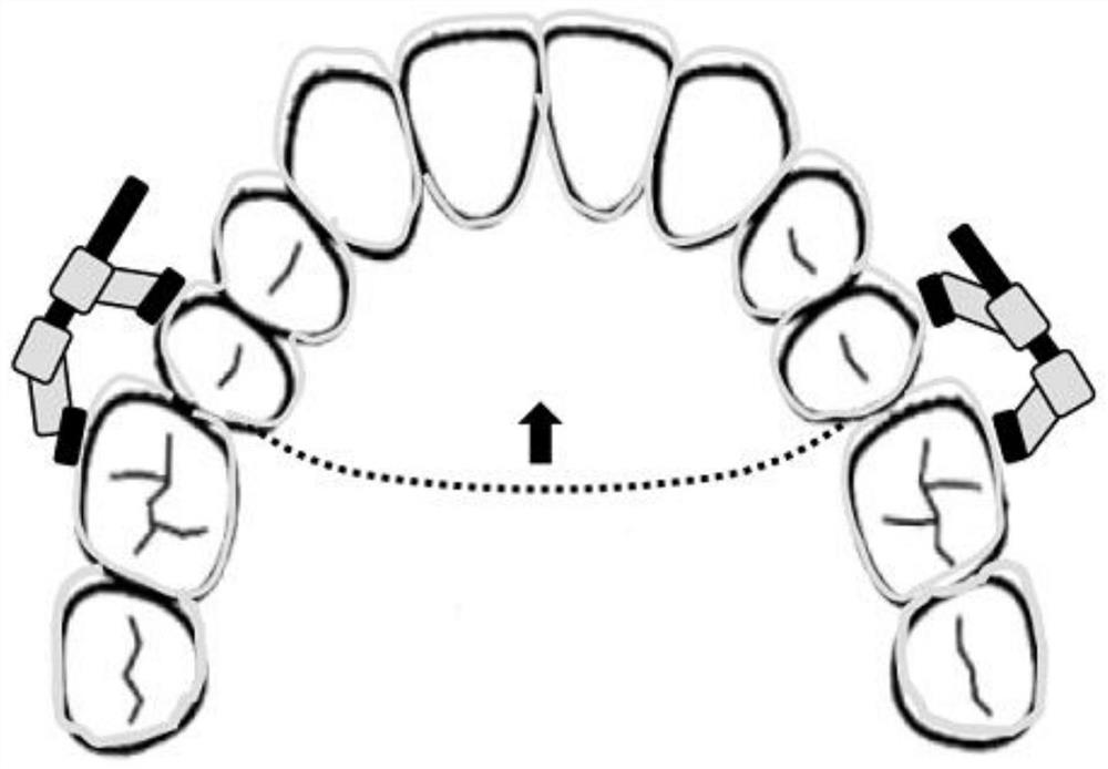 A Direction-Adjustable Anterior Maxillary Retractor and Its Clinical Application