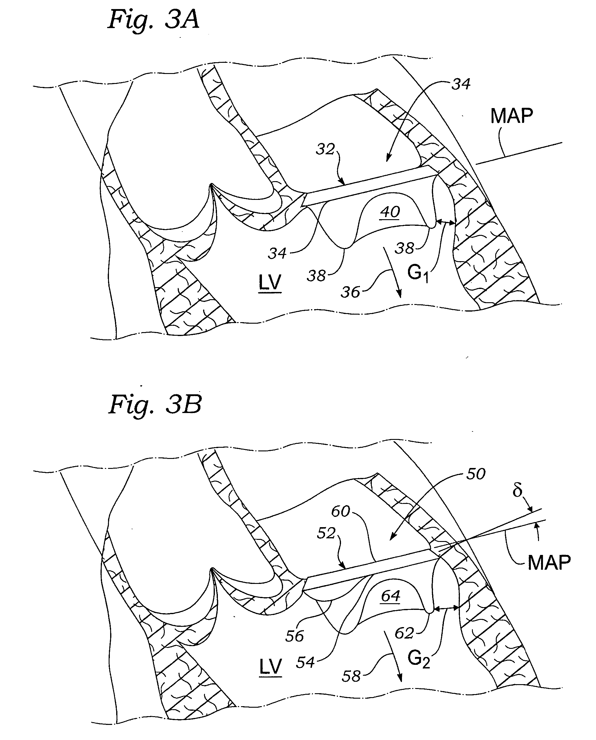 Methods of implanting a prosthetic mitral heart valve having a contoured sewing ring