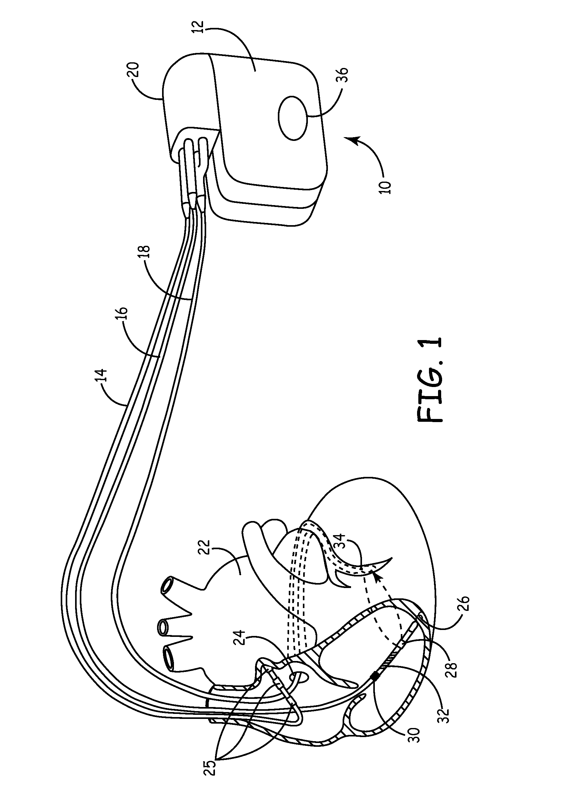 Pressure and impedance based discrimination of hemodynamic stability