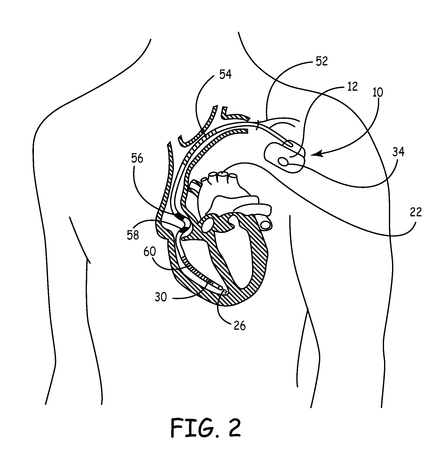 Pressure and impedance based discrimination of hemodynamic stability