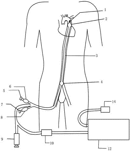 Aortic intracavitary double-horizontal-sacculus blockage pressurized infusion system