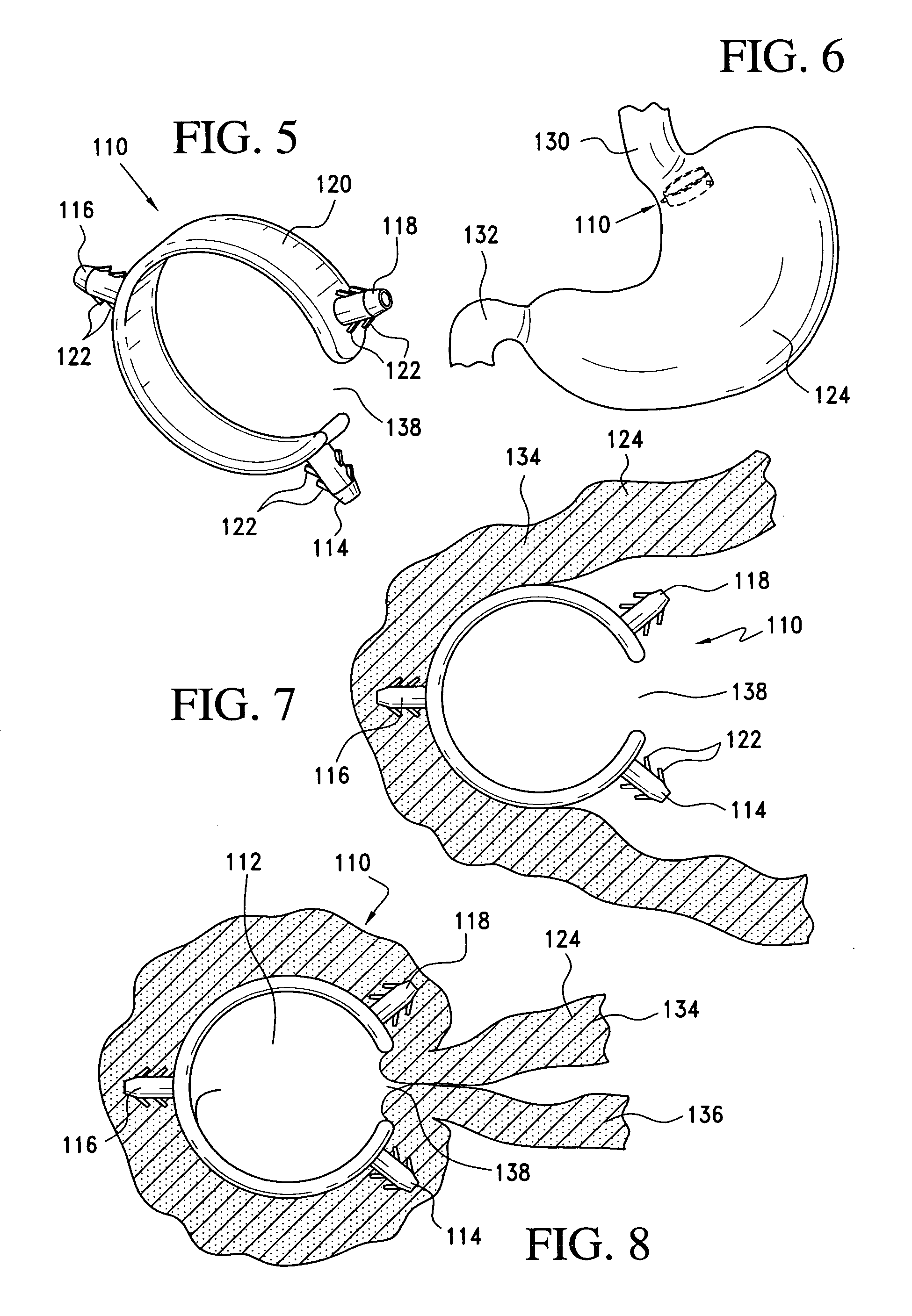 Method and clamp for gastric reduction surgery
