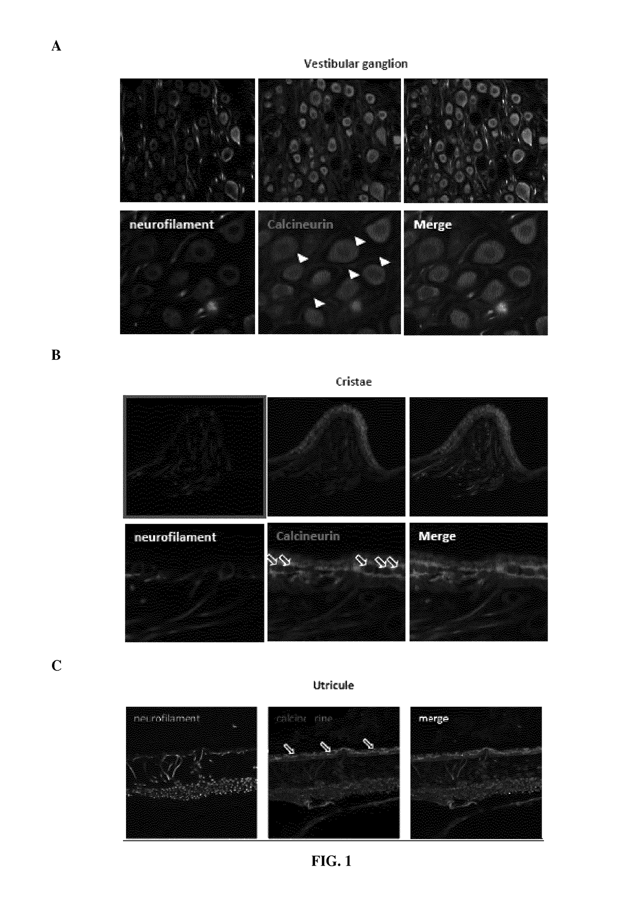 Calcineurin inhibitors for use in the treatment of lesional vestibular disorders