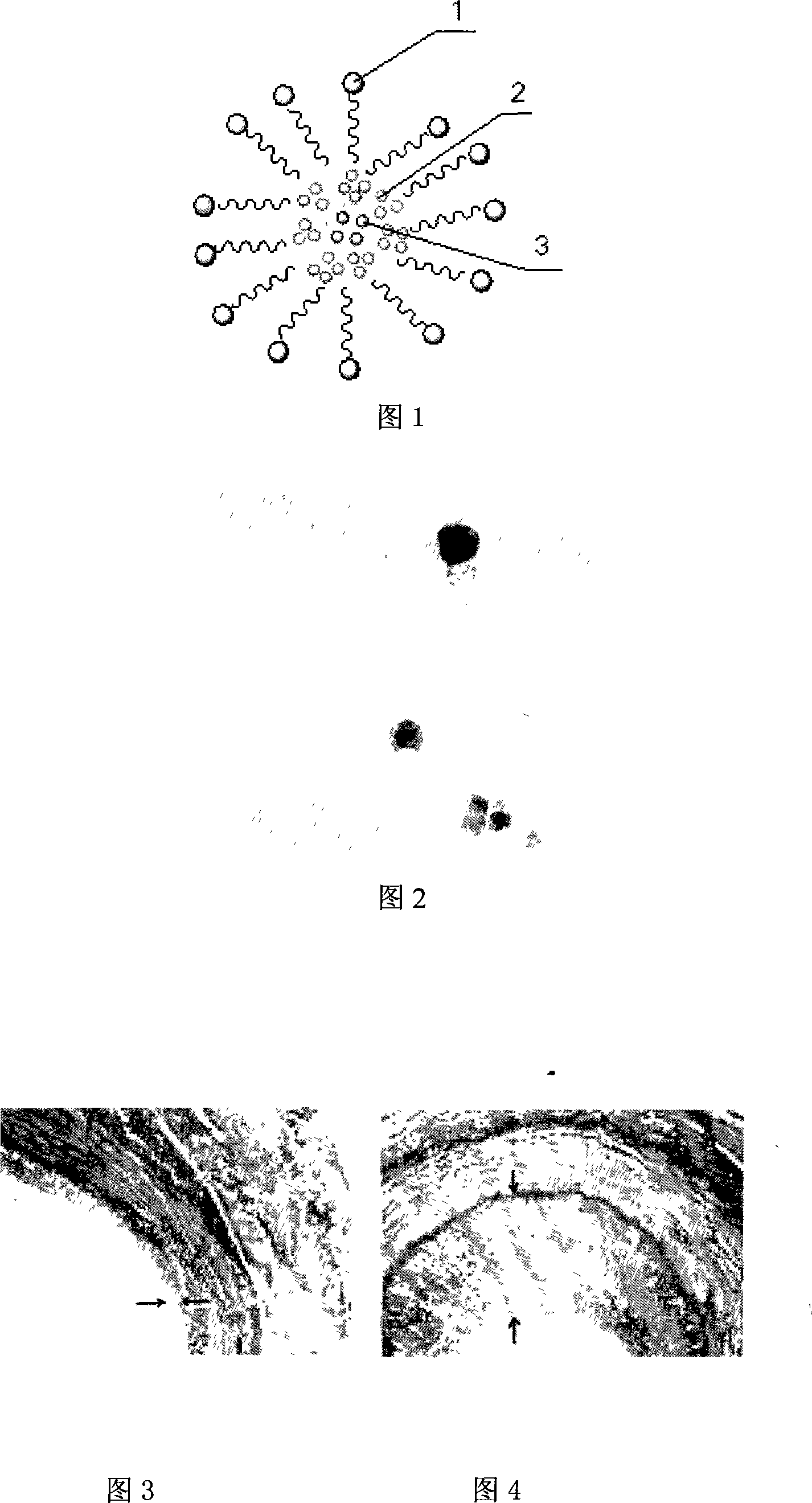 Dual functional polymer nanometer glue bunch and preparing method and application in preparing medicine for treating second narrow blood vessel