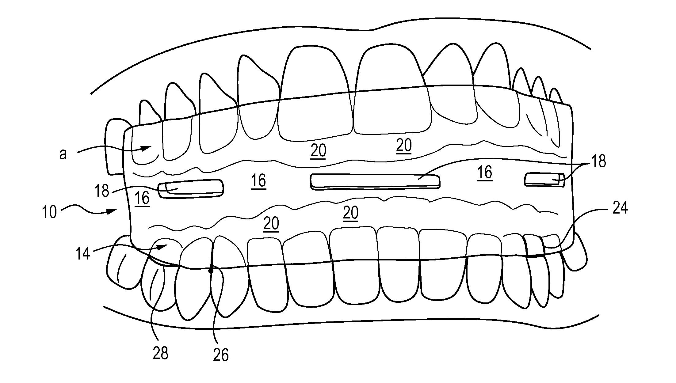 Apparatus and method for treatment of sleep apnea and snoring
