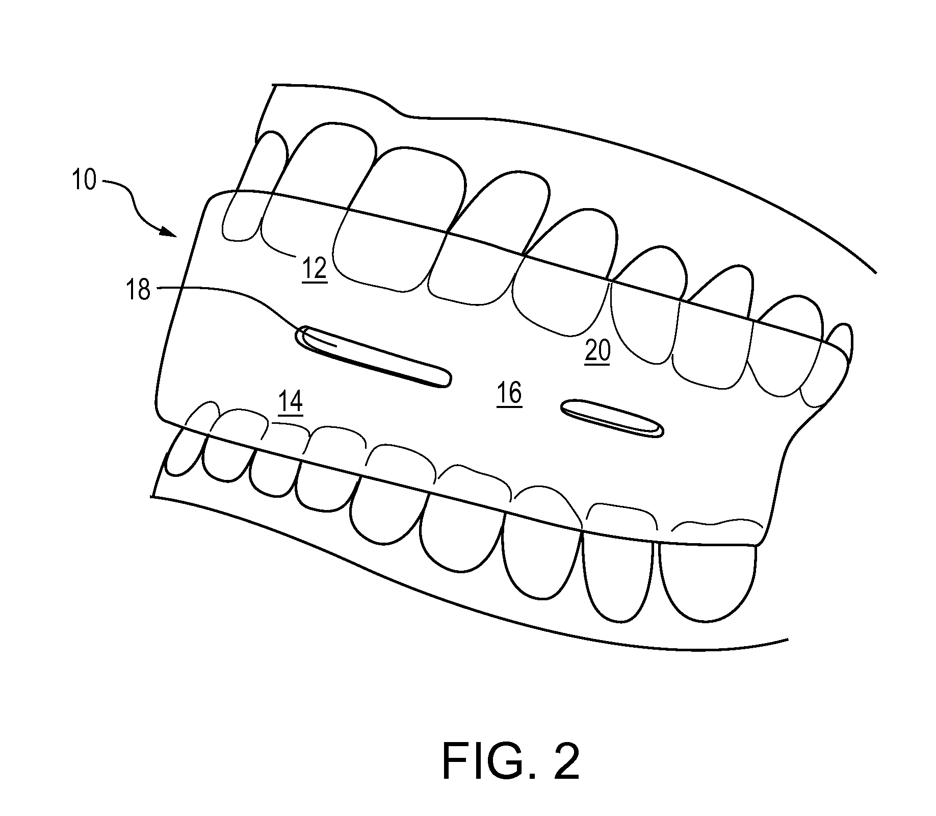 Apparatus and method for treatment of sleep apnea and snoring
