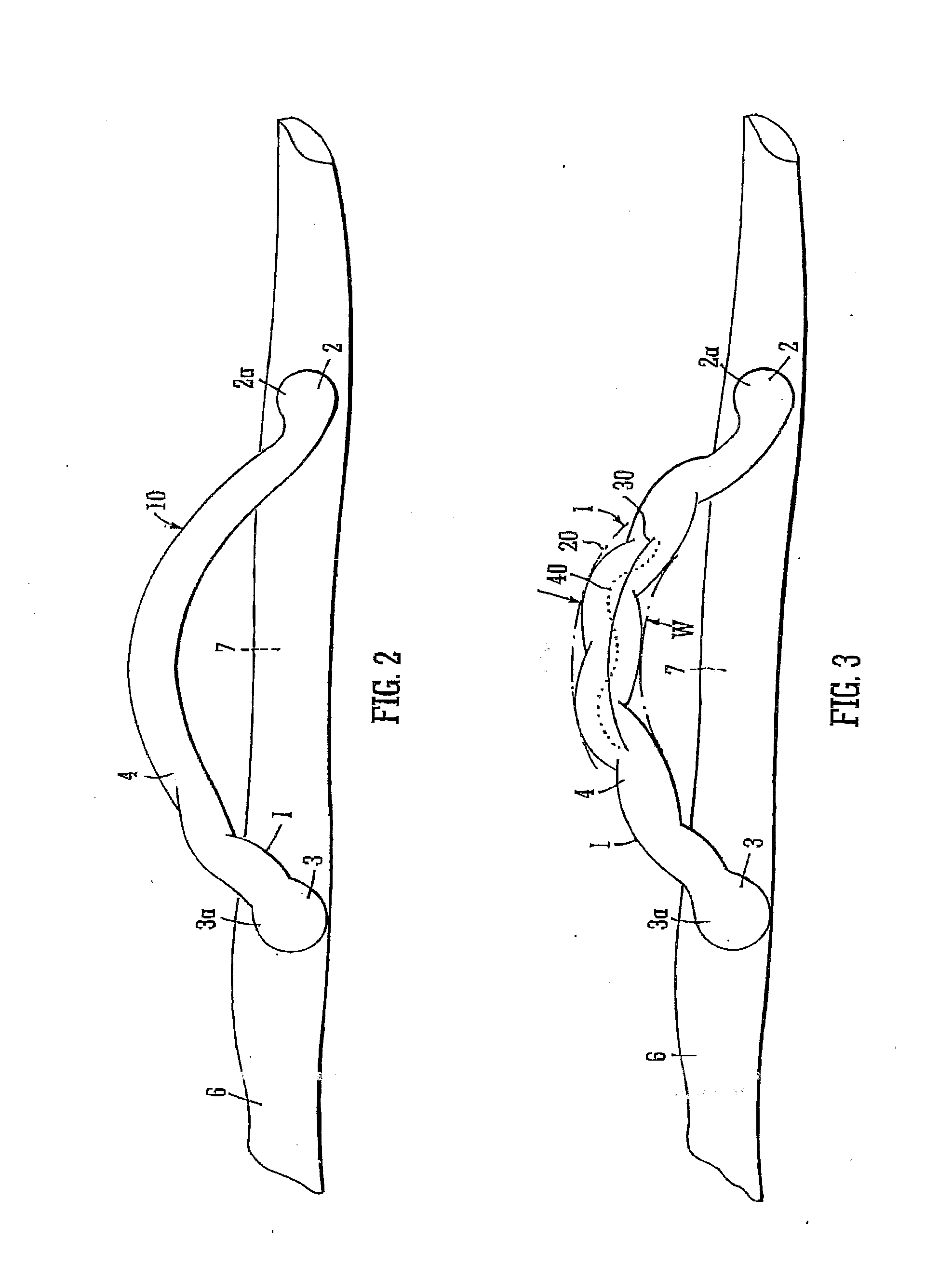 Helical graft