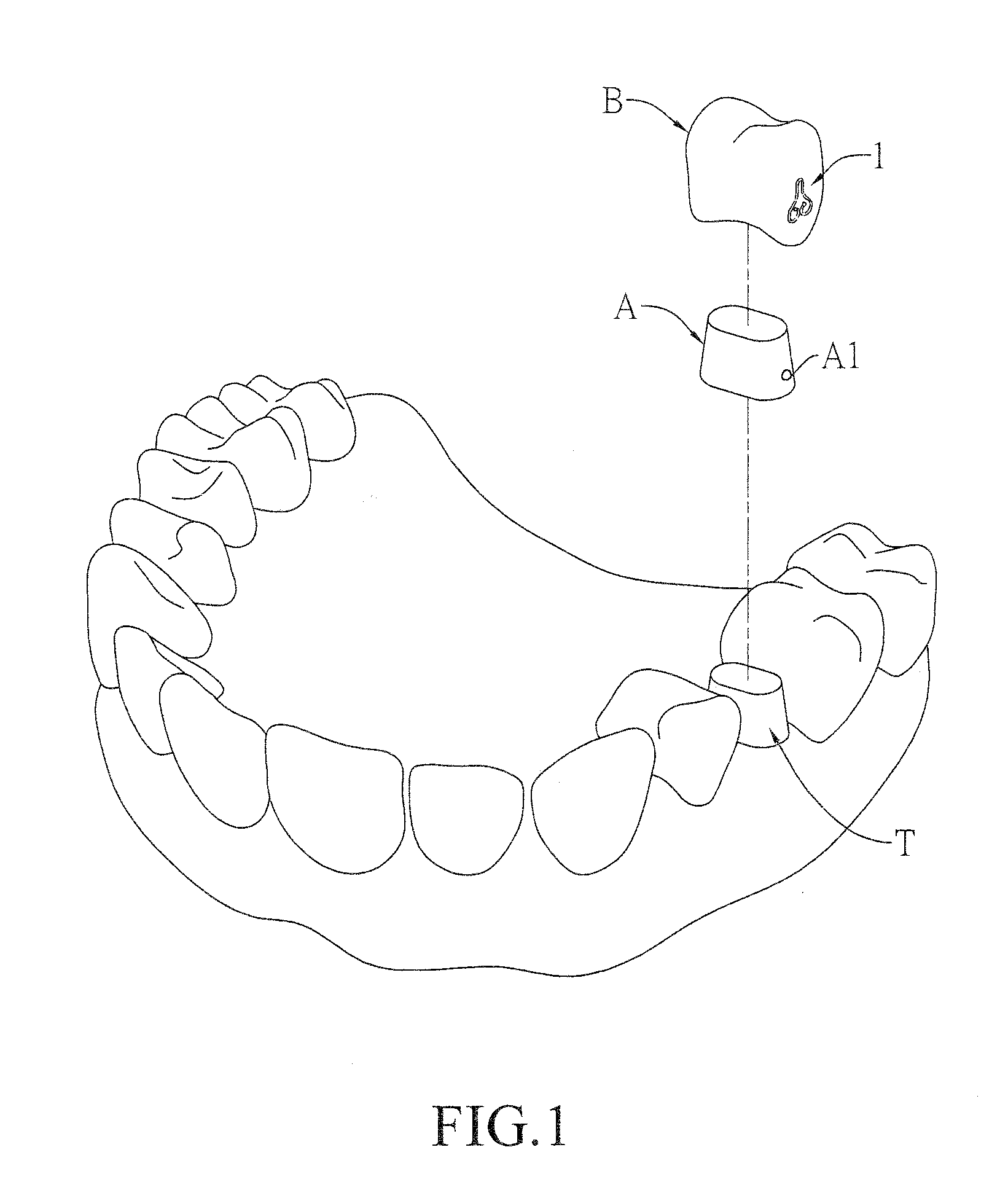 Spring clip mounted to withdrawable artificial tooth and removable artificial tooth assembled with same