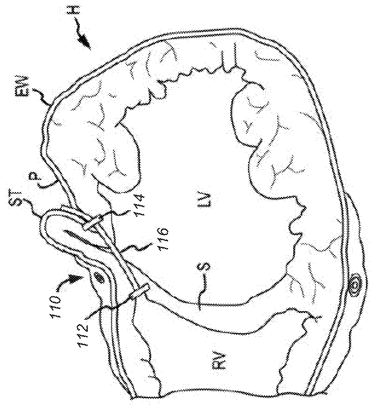 Tissue protecting devices for treatmentof congestive heart failure and other conditions