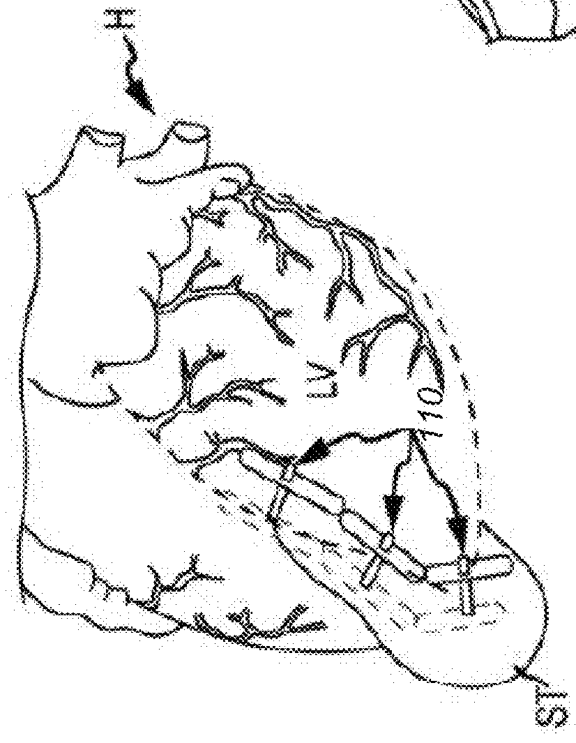 Tissue protecting devices for treatmentof congestive heart failure and other conditions