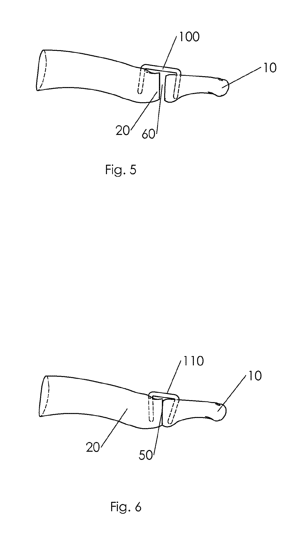 Shape changing bone implant and method of use for enhancing healing