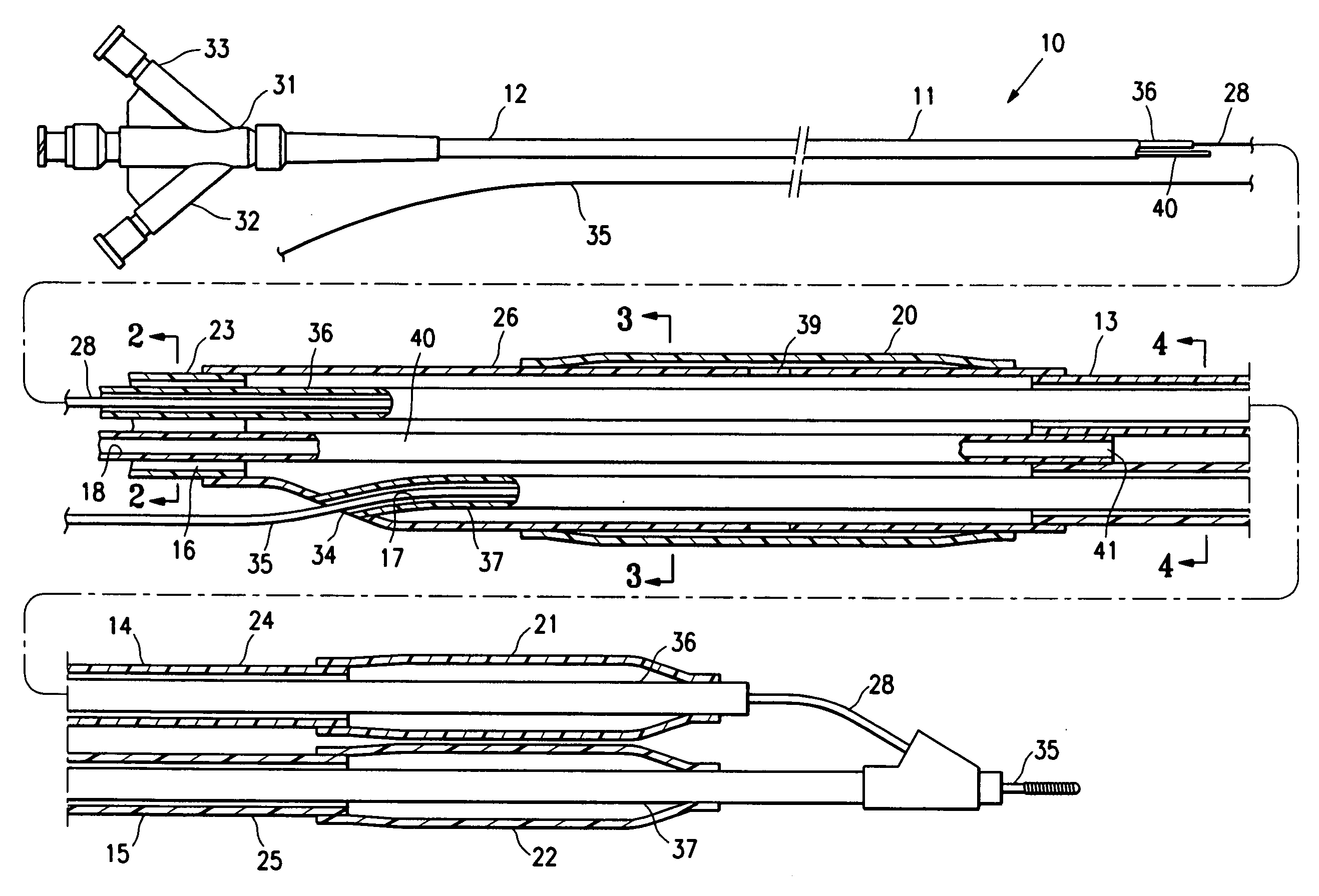 Bifurcated catheter for agent delivery and method of agent delivery
