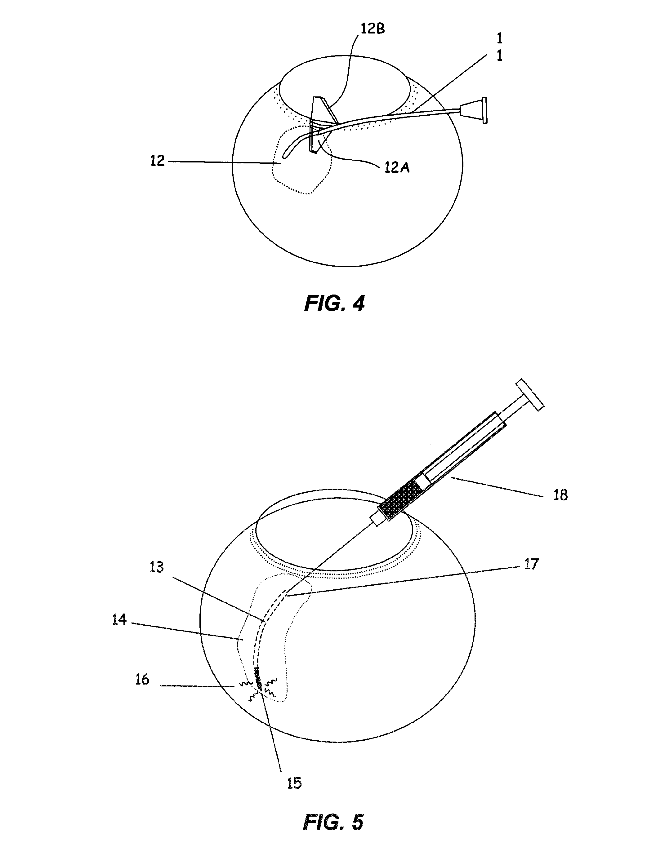 Apparatus and method for ocular treatment