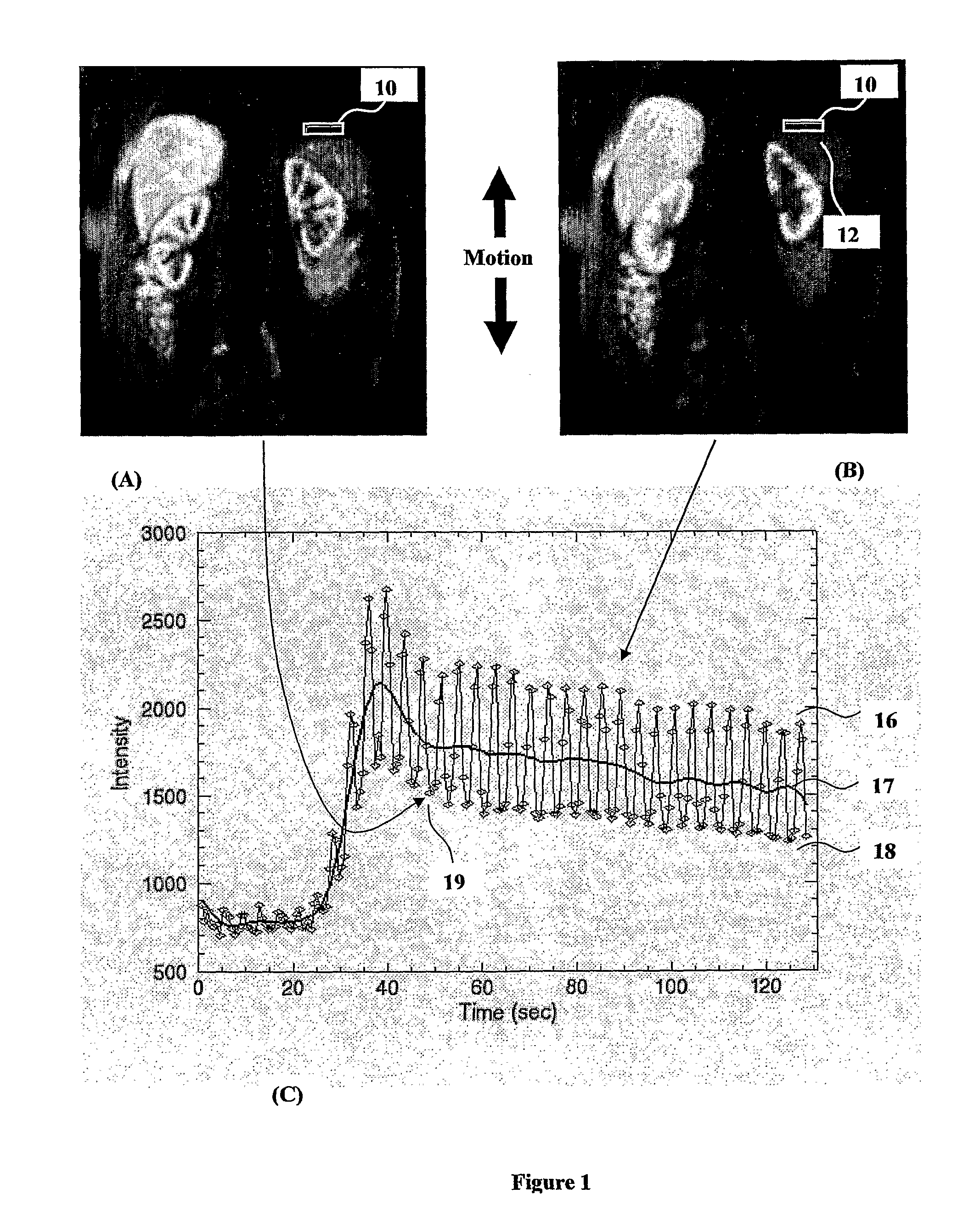 Method and system of motion artefact compensation in a subject